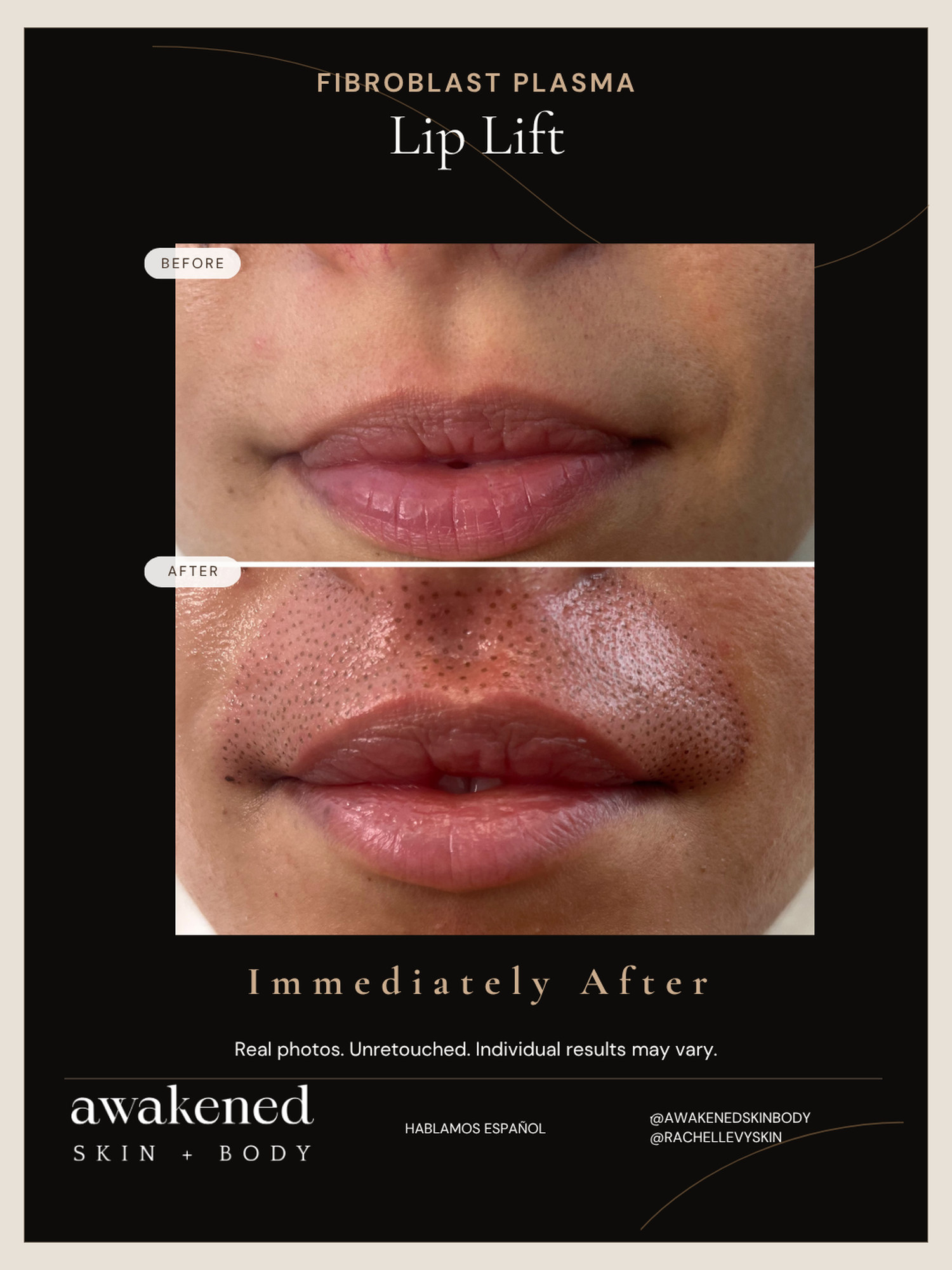 Lip lift before and after, Fibroblast Plasma