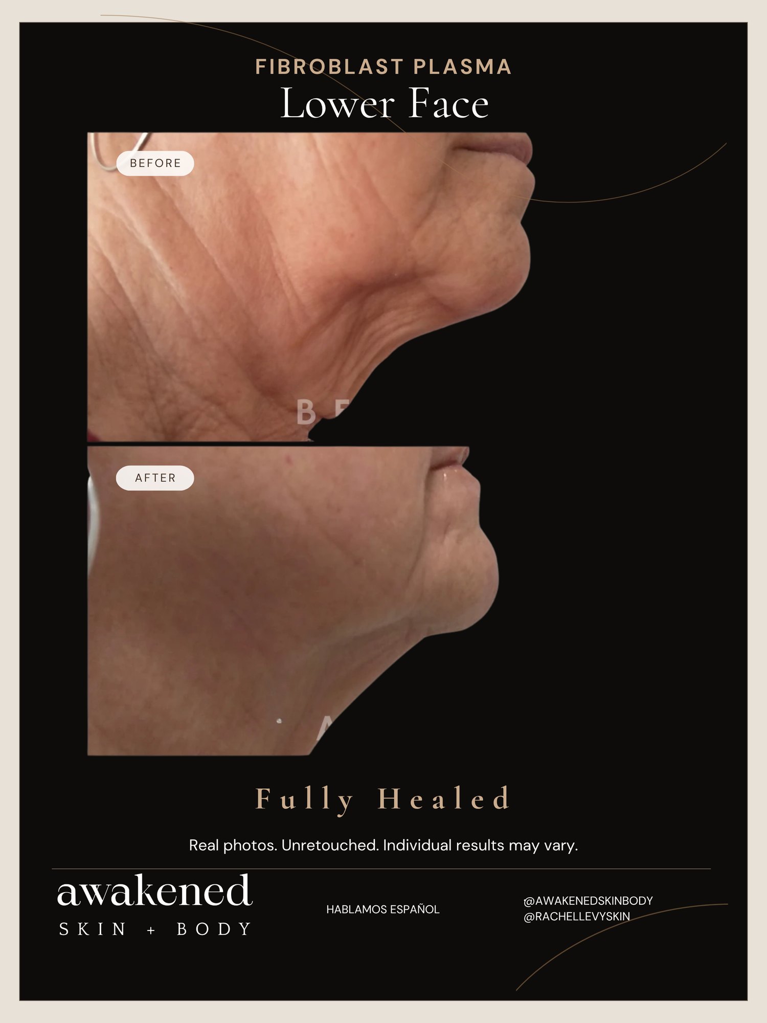 Fibroblast plasma lower face before and after