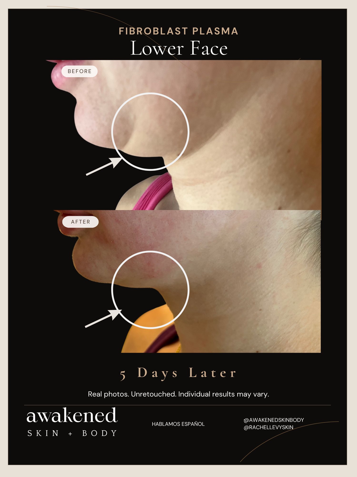 Fibroblast jawline before and after, real client