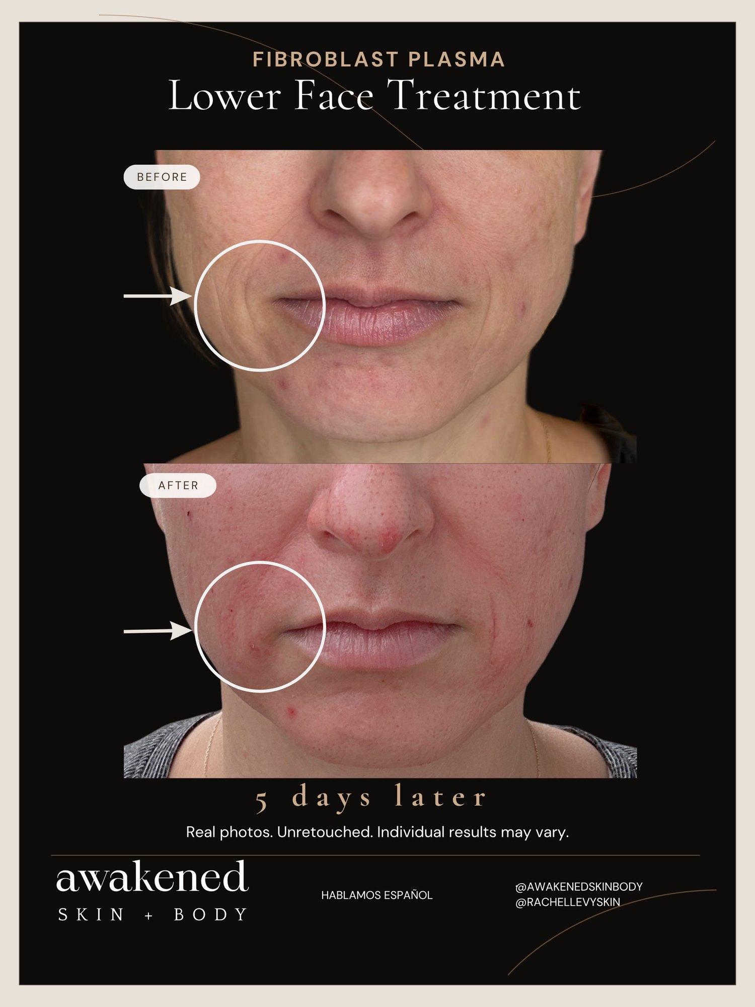 Lower Face before and after, Fibroblast Plasma