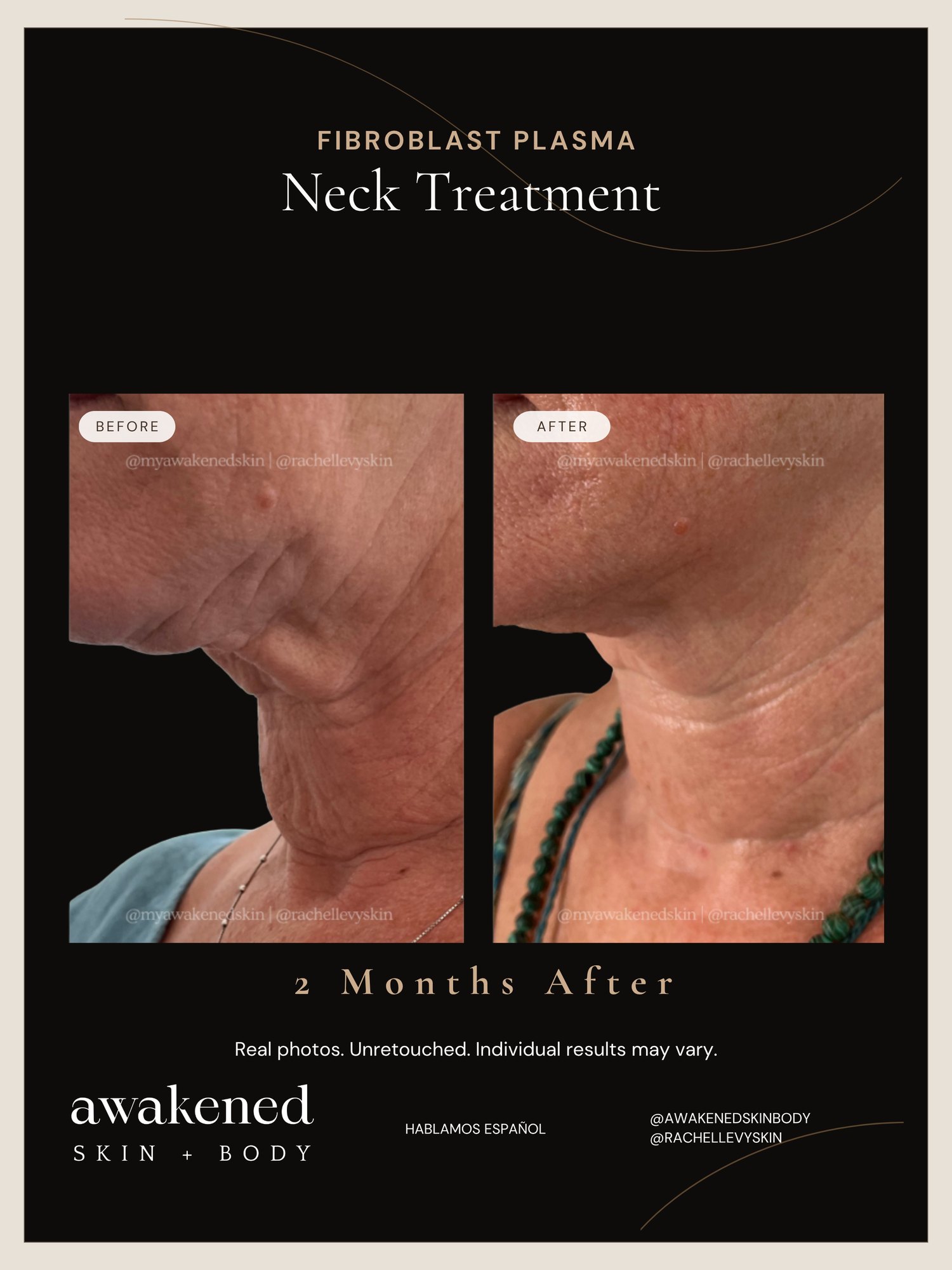 Fibroblast plasma neck lift before and after