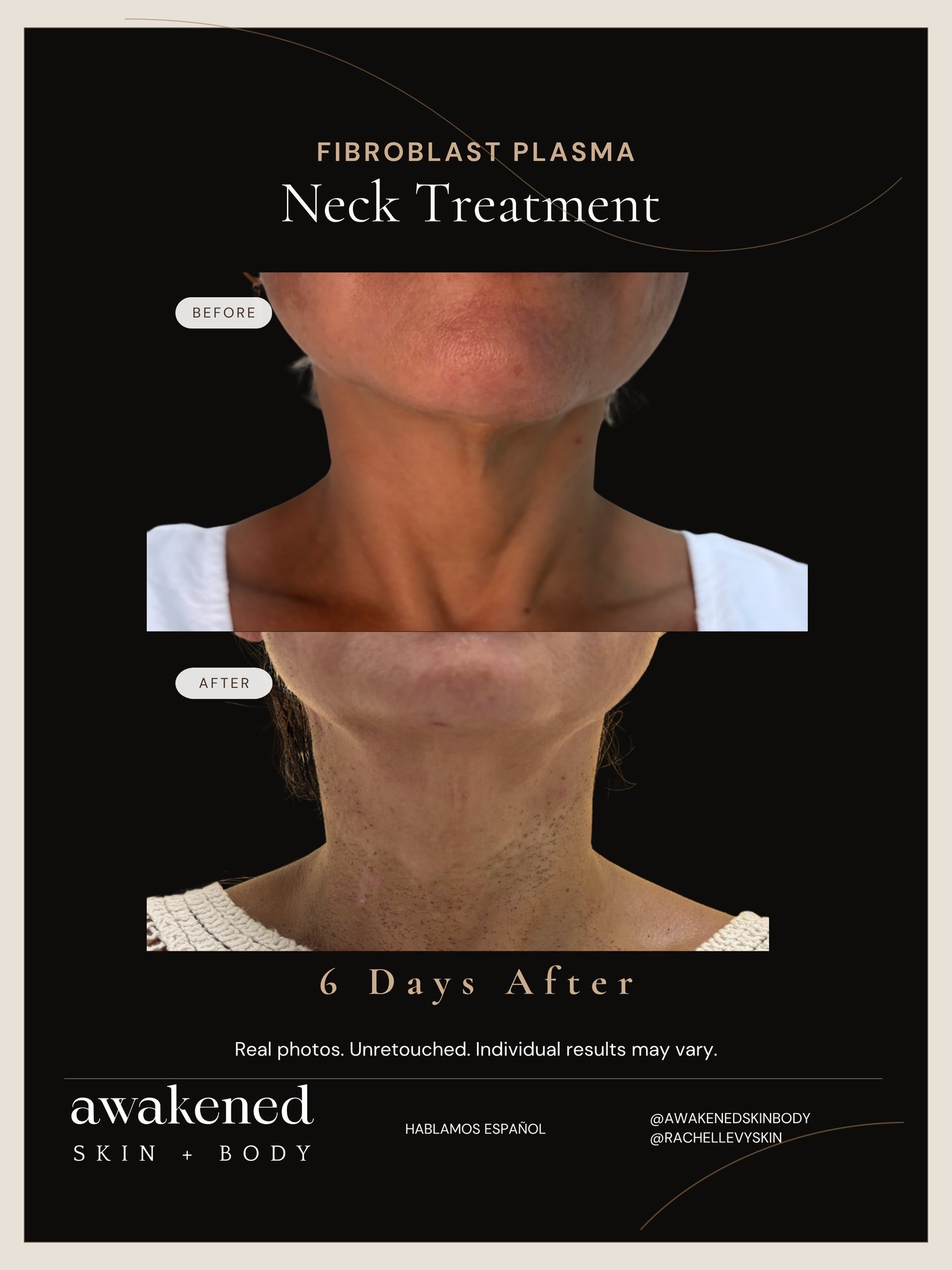 Fibroblast crepey neck before and after, real client