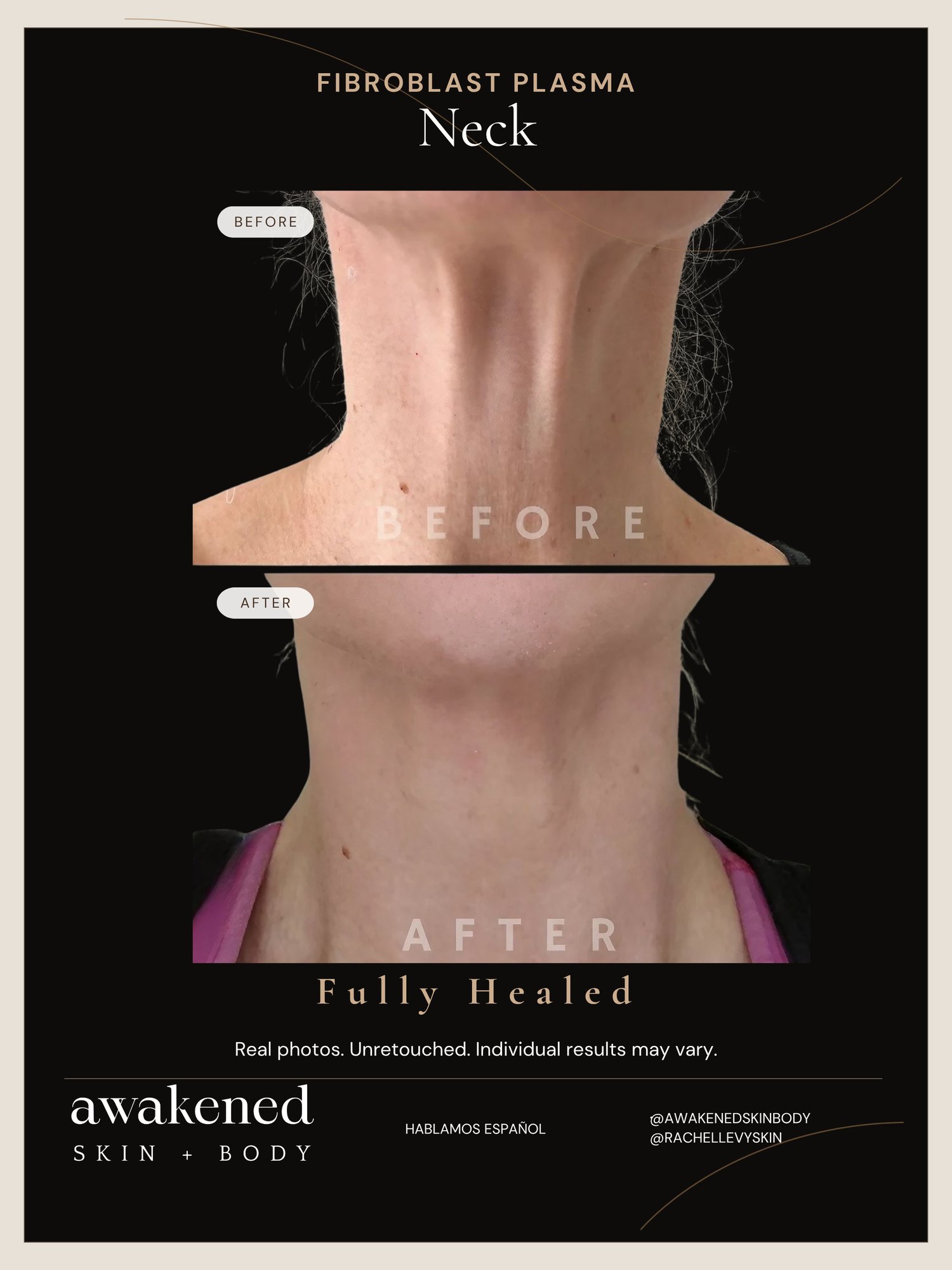 Fibroblast neck tightening before and after, non-surgical