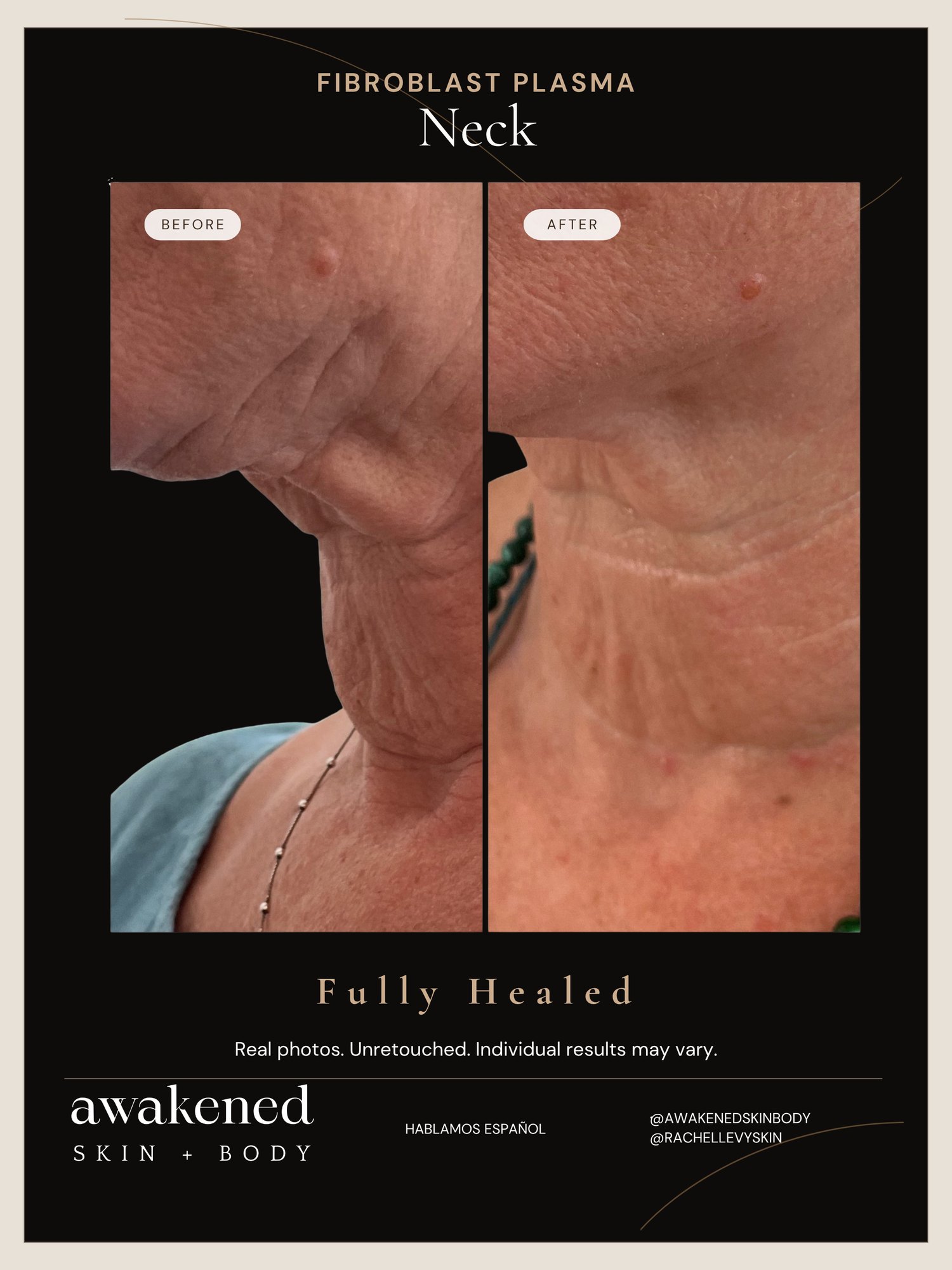 Neck before and after, Fibroblast Plasma