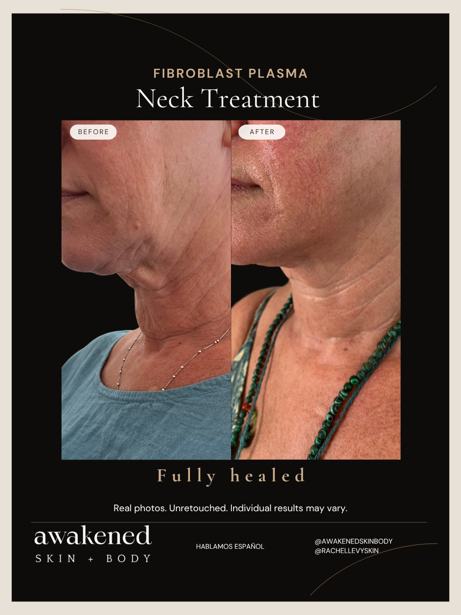 Neck before and after, Fibroblast Plasma