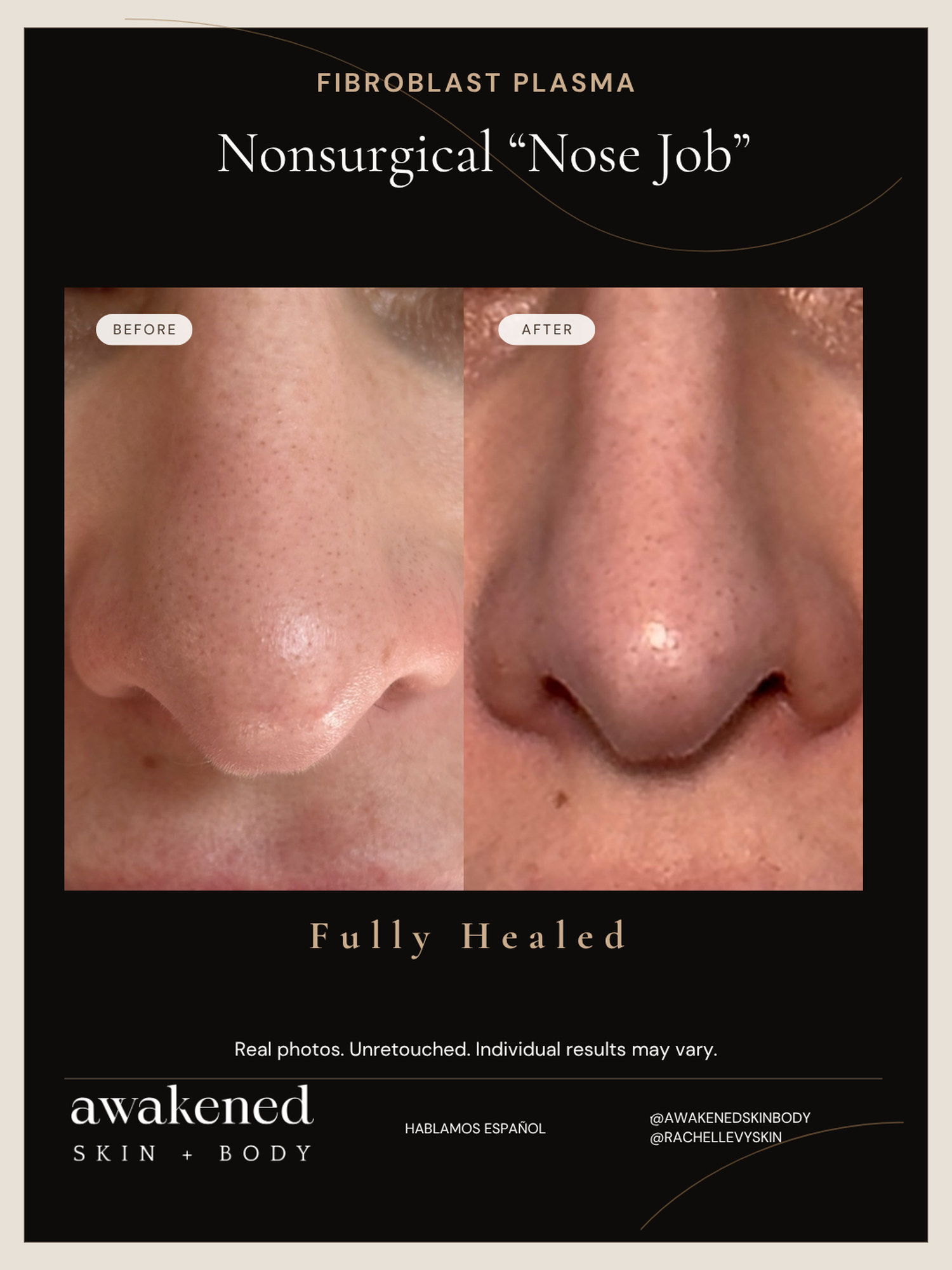 Nonsurgical nose job before and after, Fibroblast Plasma