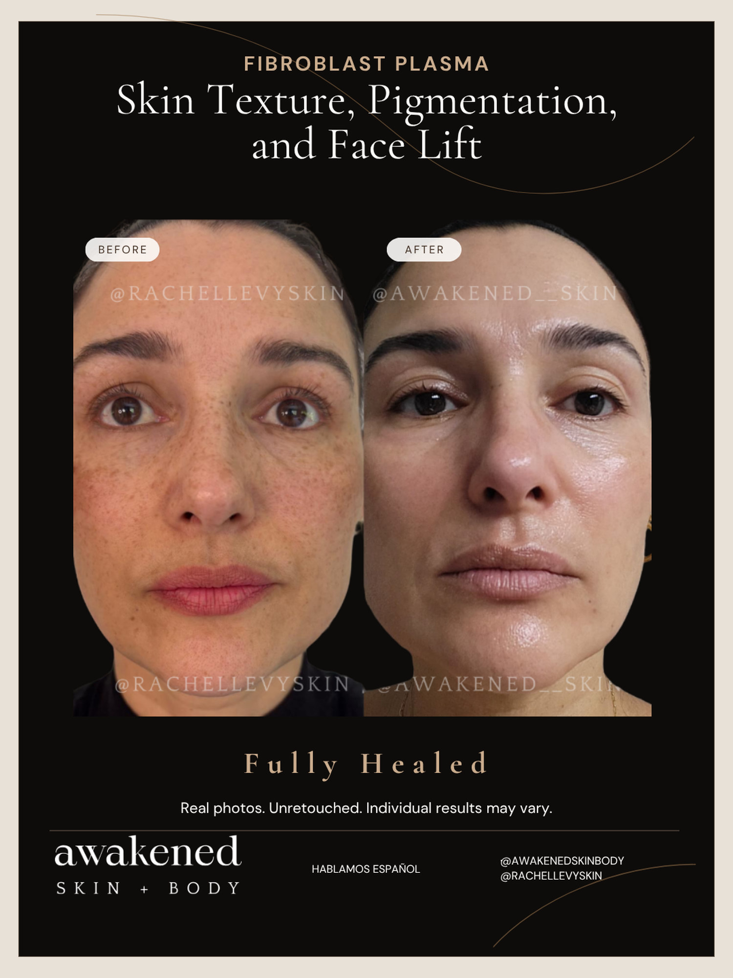 Texture, pigment and face lift before and after, Fibroblast Plasma