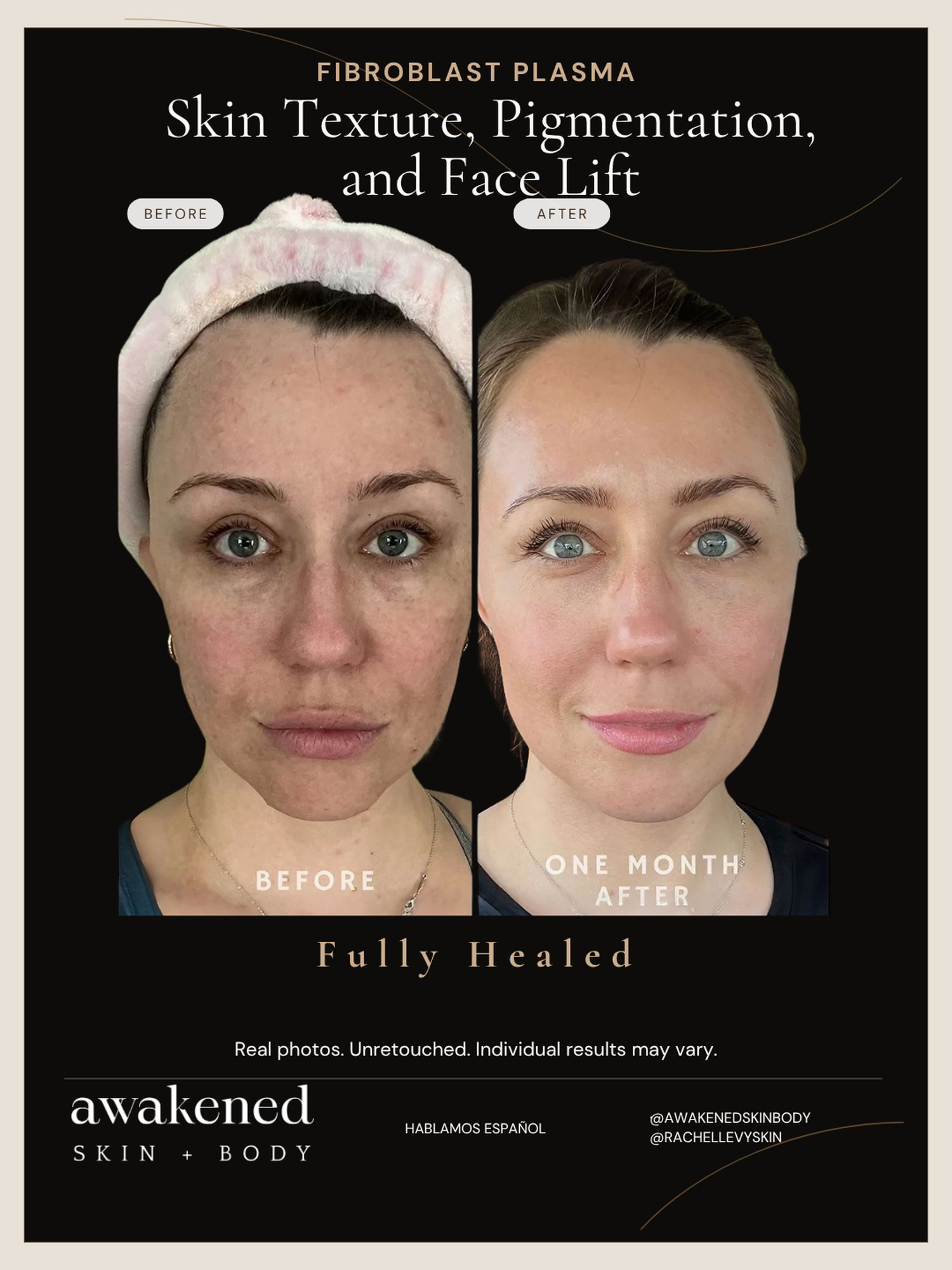 Texture, pigment and face lift before and after, Fibroblast Plasma