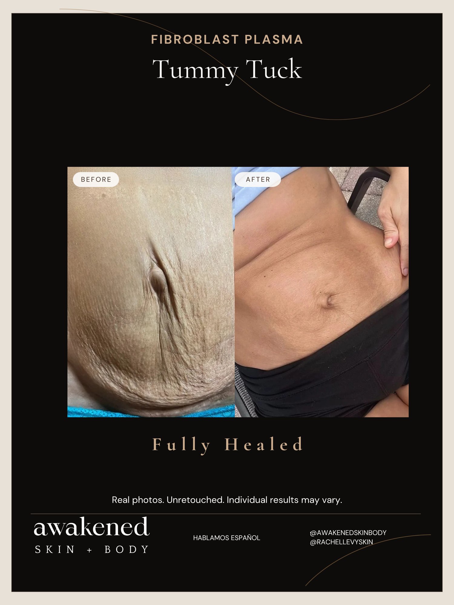 Post-baby abdomen firming, before and after