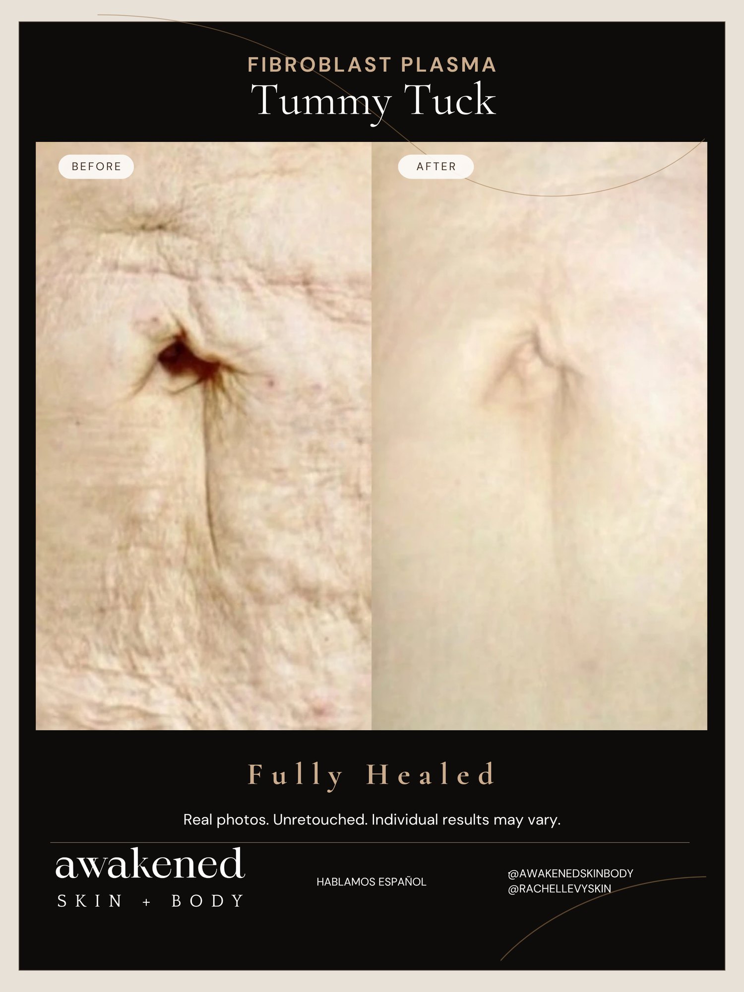 Tummy before and after, Fibroblast Plasma