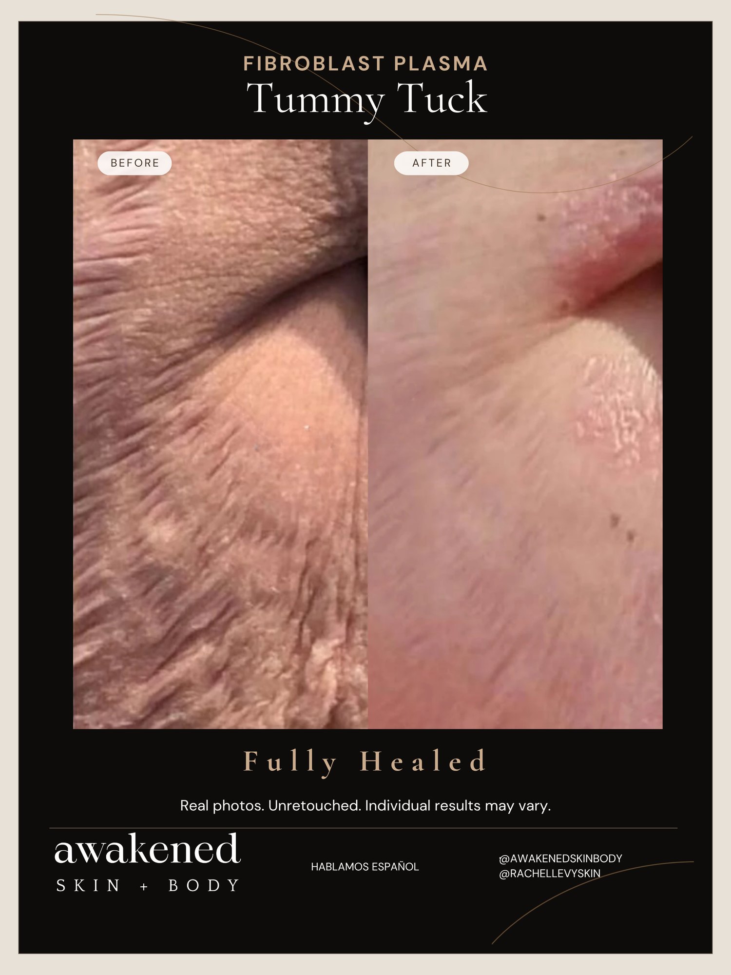 Tummy before and after, Fibroblast Plasma