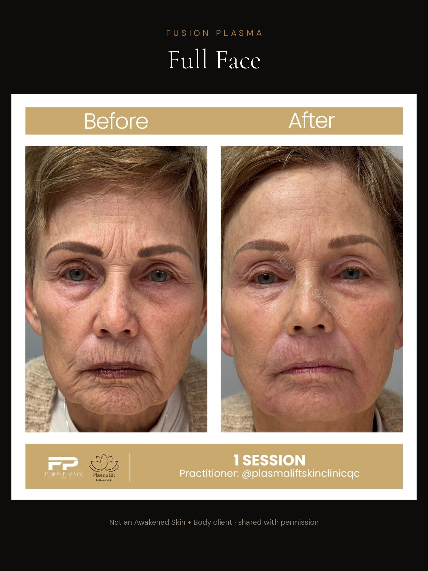 Full Face before and after, Fusion Plasma, result by a certified practitioner outside our studio