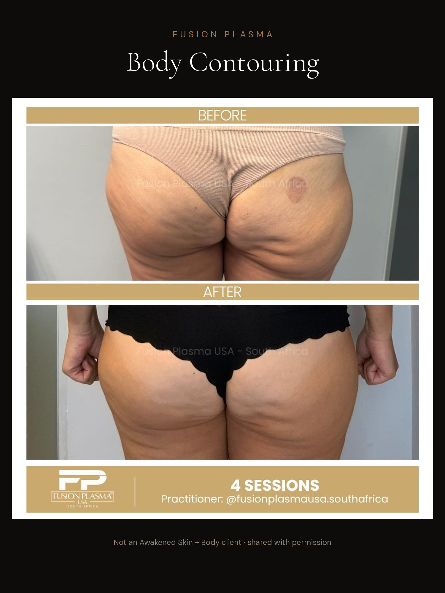 Body Contouring before and after, Fusion Plasma, result by a certified practitioner outside our studio