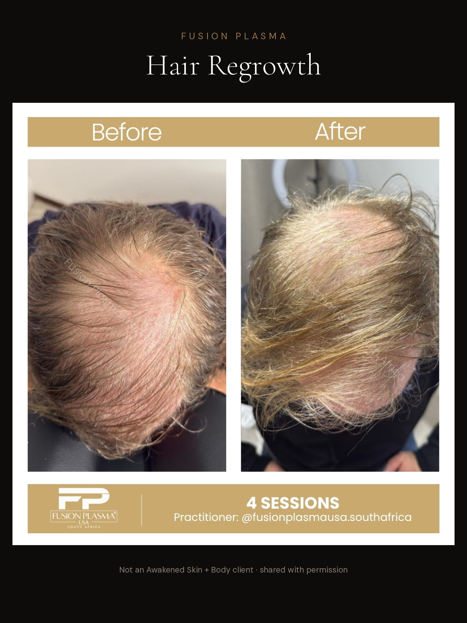 Hair Regrowth before and after, Fusion Plasma, result by a certified practitioner outside our studio