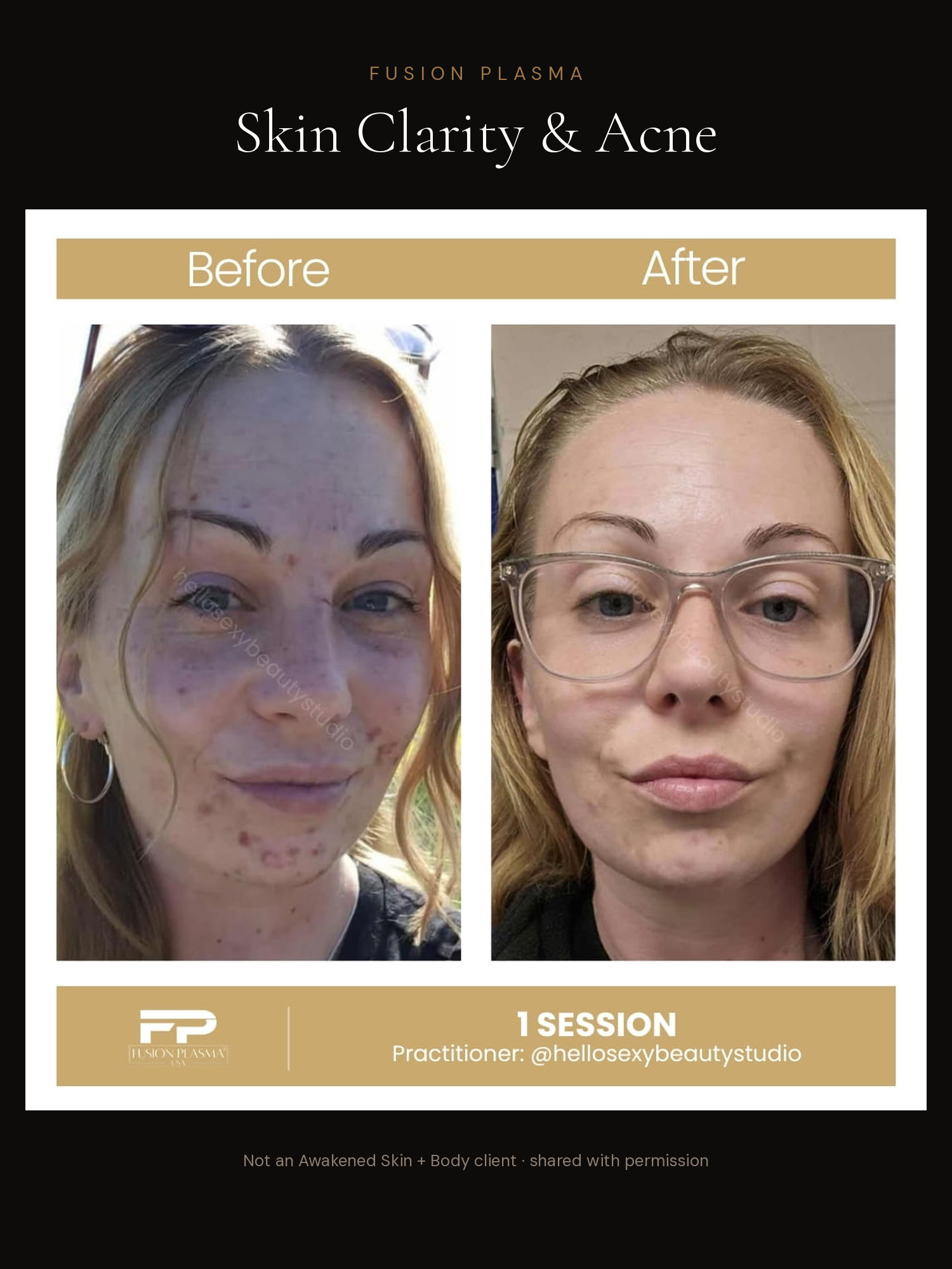 Skin Clarity & Acne before and after, Fusion Plasma, result by a certified practitioner outside our studio