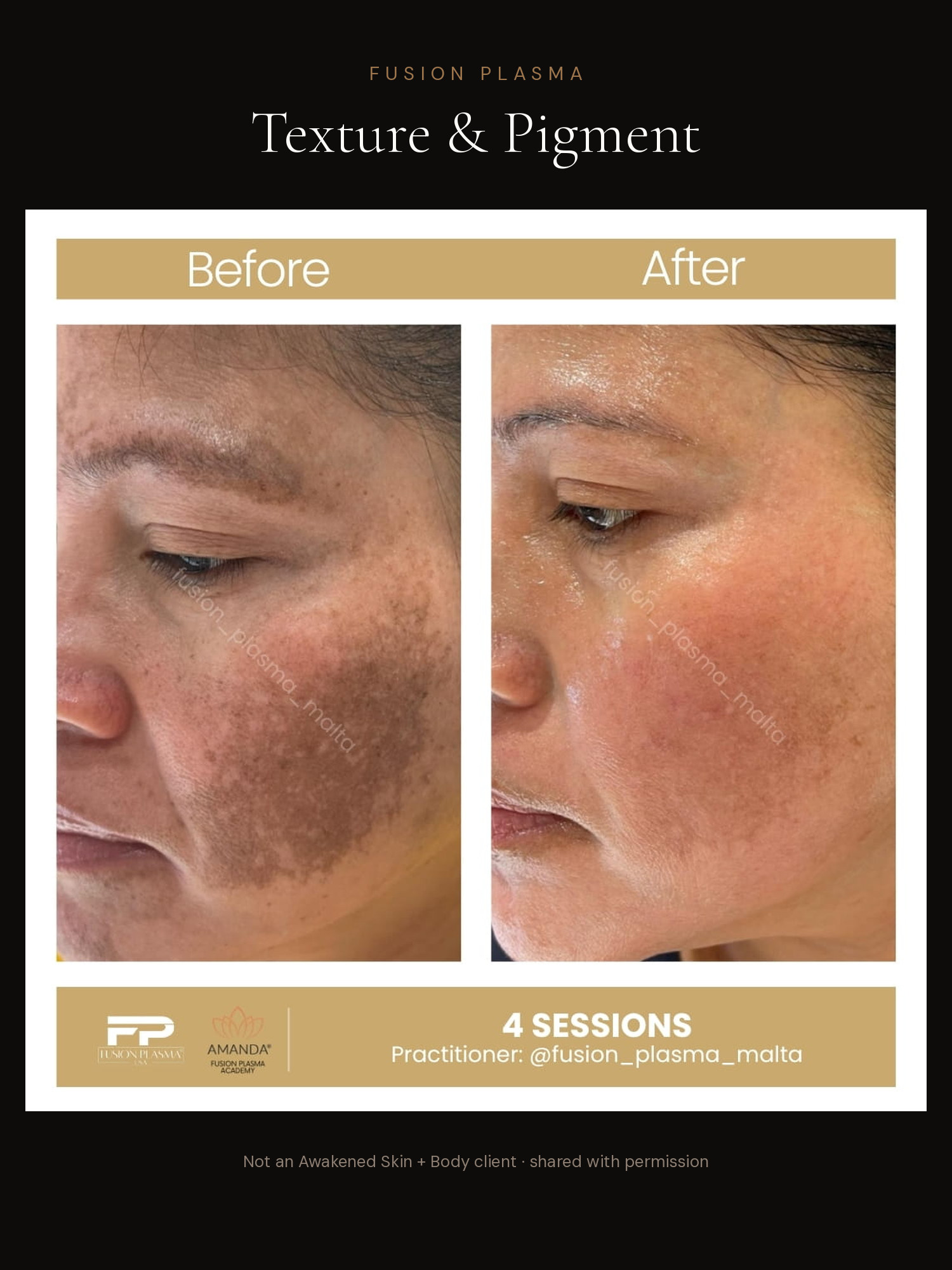 Texture & Pigment before and after, Fusion Plasma, result by a certified practitioner outside our studio