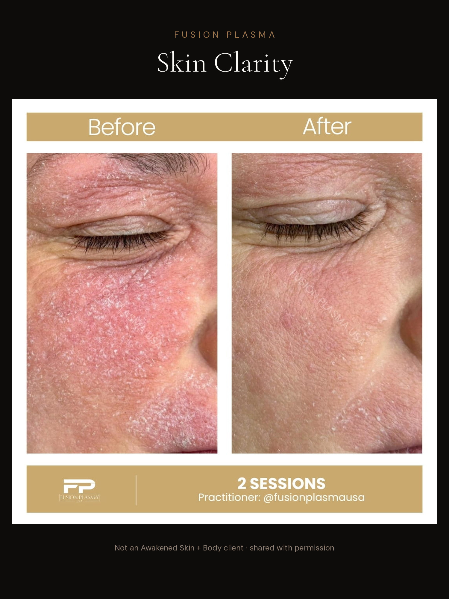 Skin Clarity before and after, Fusion Plasma, result by a certified practitioner outside our studio