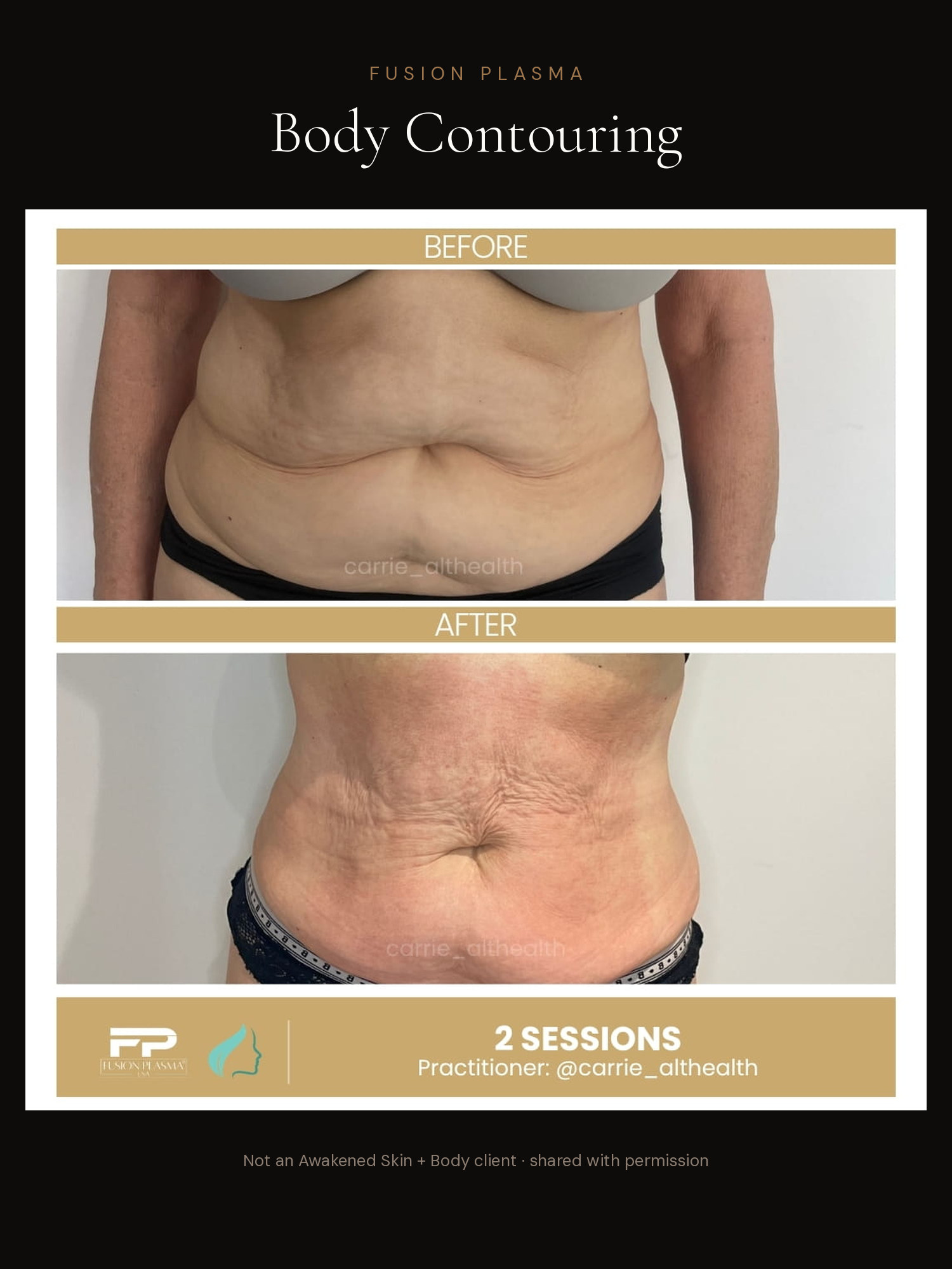 Body Contouring before and after, Fusion Plasma, result by a certified practitioner outside our studio