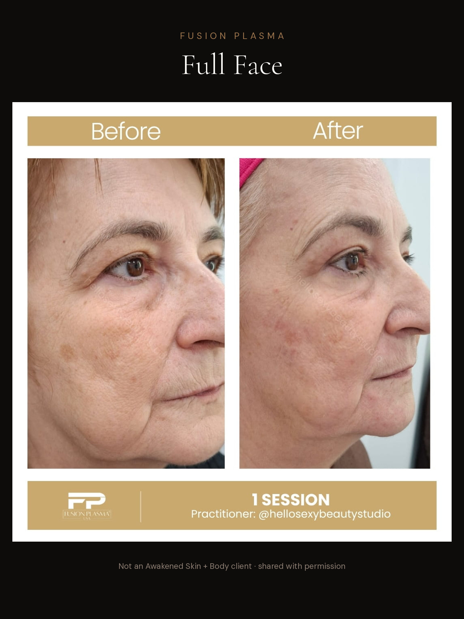 Full Face before and after, Fusion Plasma, result by a certified practitioner outside our studio