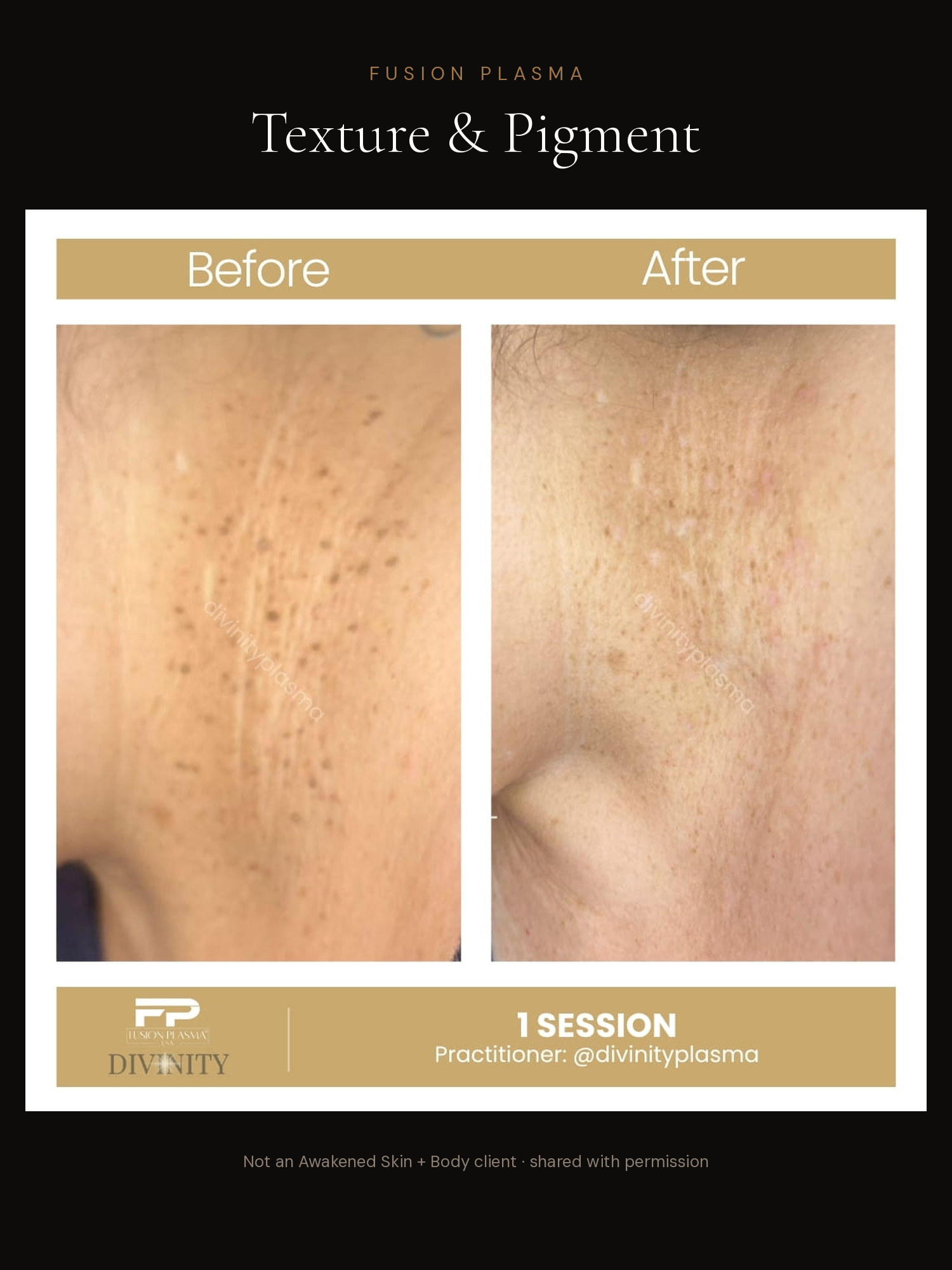 Texture & Pigment before and after, Fusion Plasma, result by a certified practitioner outside our studio