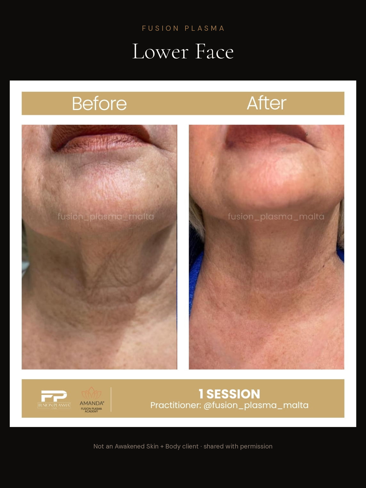 Lower Face before and after, Fusion Plasma, result by a certified practitioner outside our studio