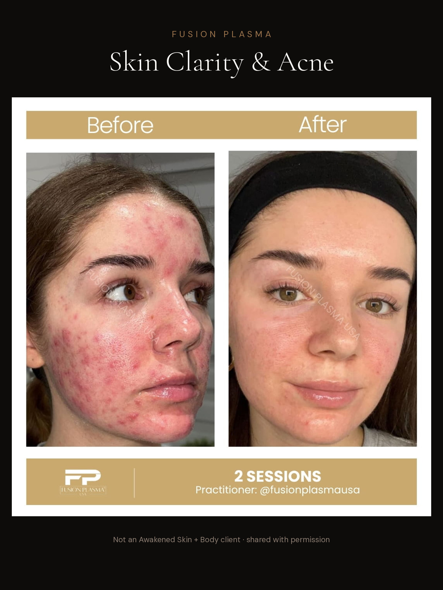 Skin Clarity & Acne before and after, Fusion Plasma, result by a certified practitioner outside our studio