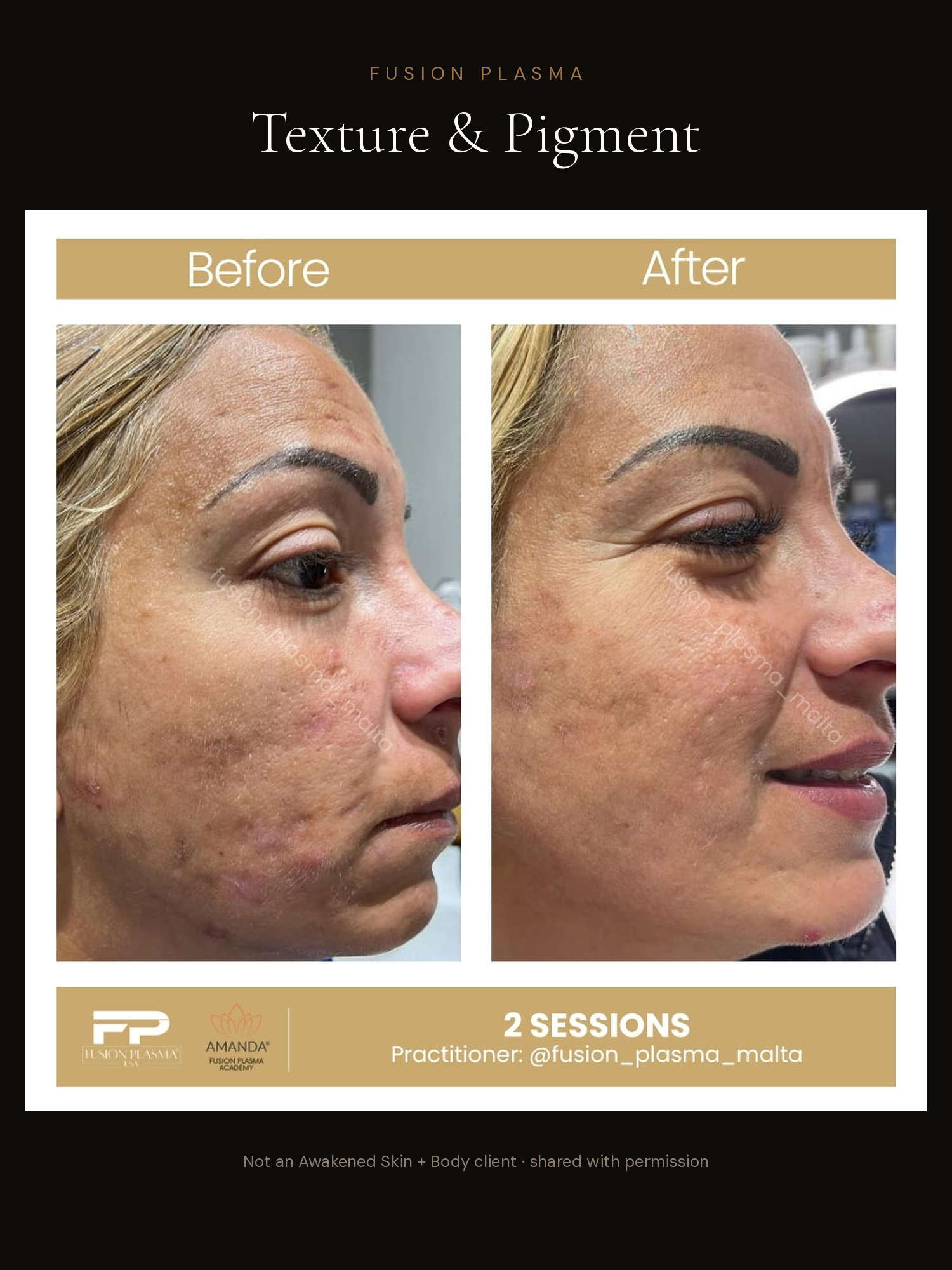 Texture & Pigment before and after, Fusion Plasma, result by a certified practitioner outside our studio