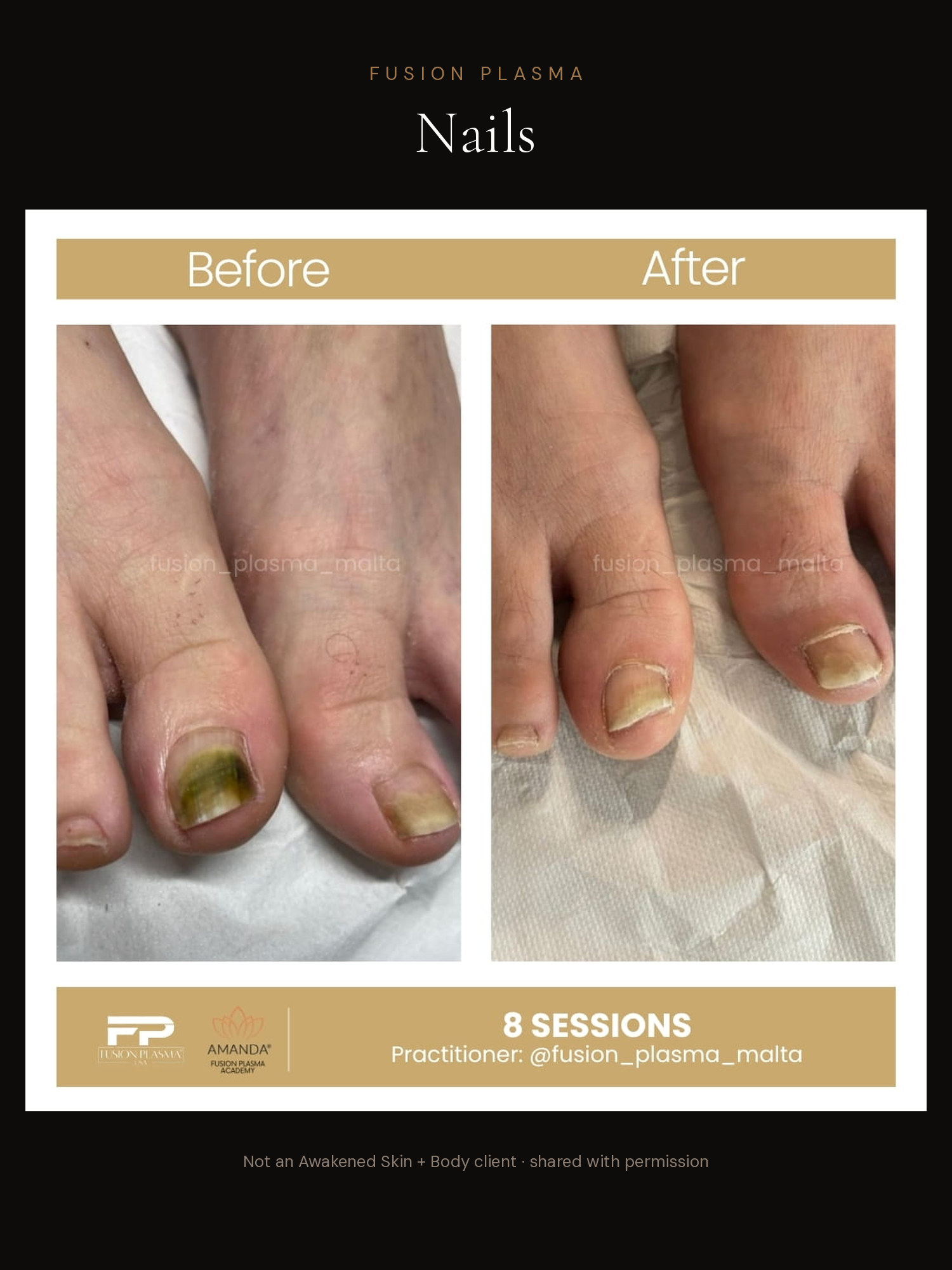 Nails before and after, Fusion Plasma, result by a certified practitioner outside our studio