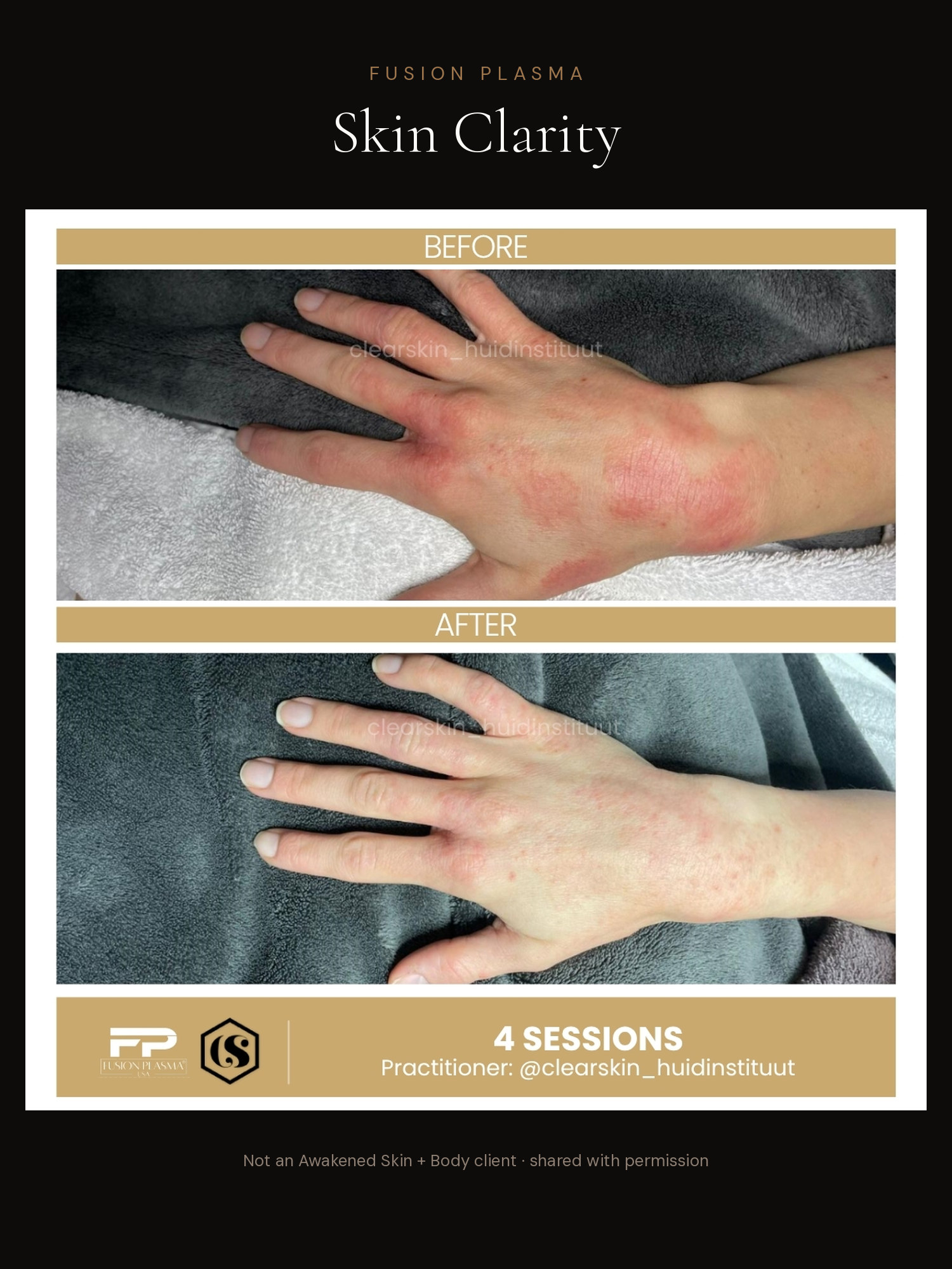 Skin Clarity before and after, Fusion Plasma, result by a certified practitioner outside our studio