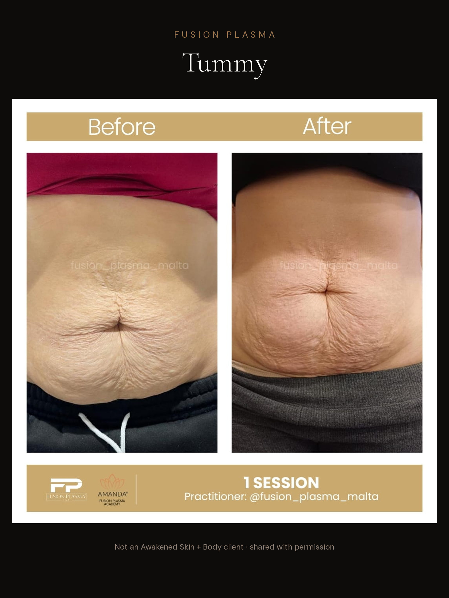 Tummy before and after, Fusion Plasma, result by a certified practitioner outside our studio