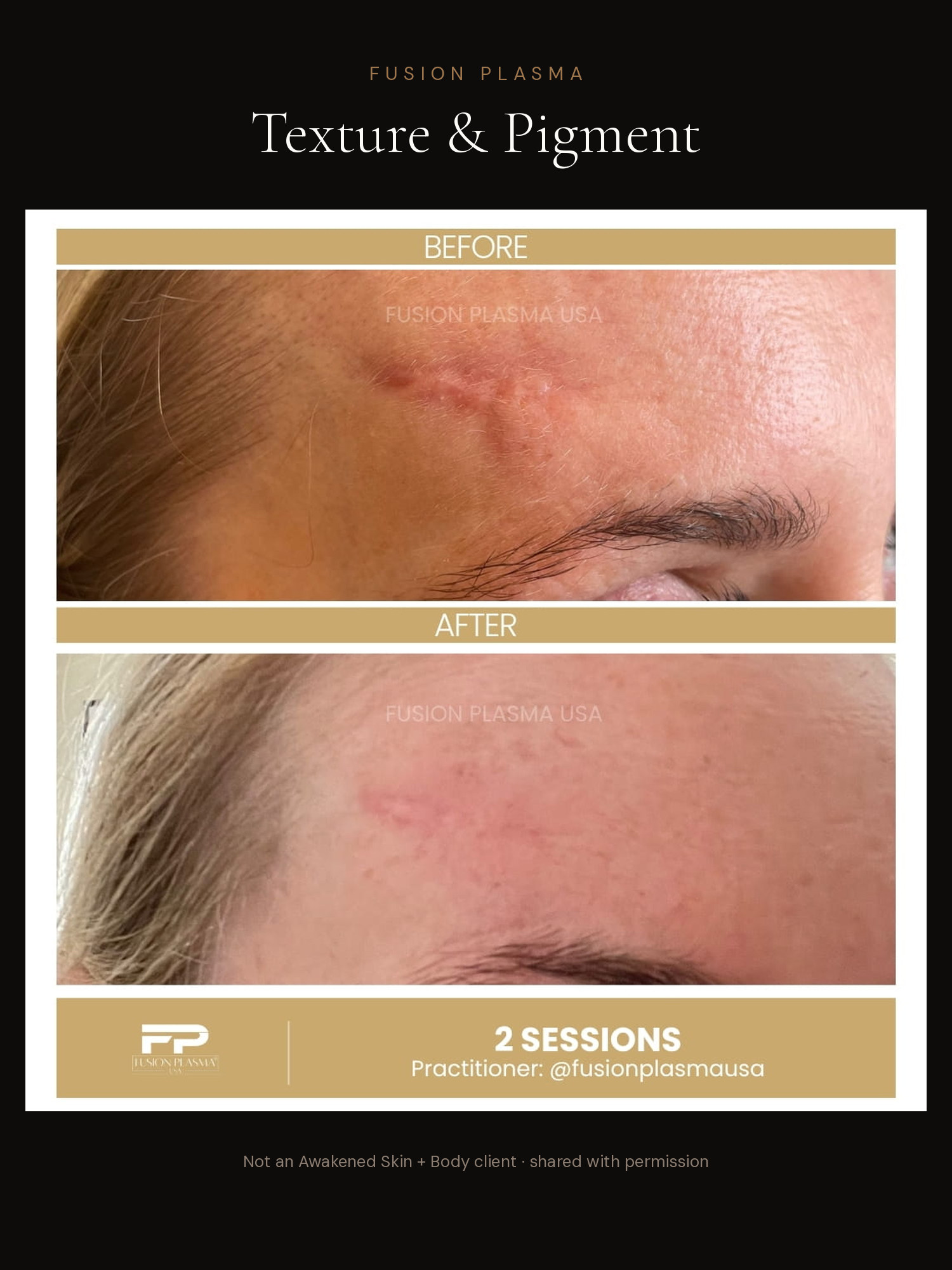 Texture & Pigment before and after, Fusion Plasma, result by a certified practitioner outside our studio