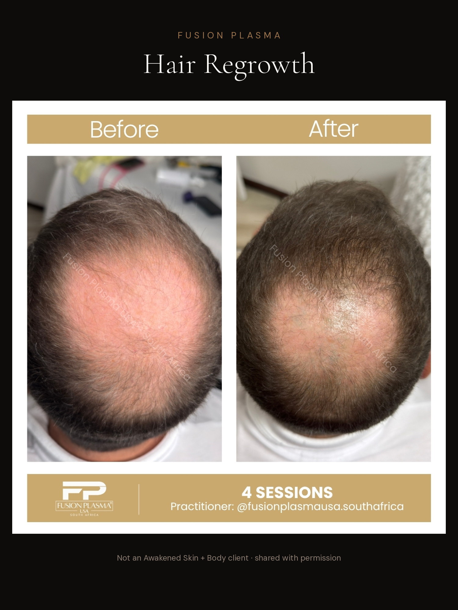 Hair Regrowth before and after, Fusion Plasma, result by a certified practitioner outside our studio