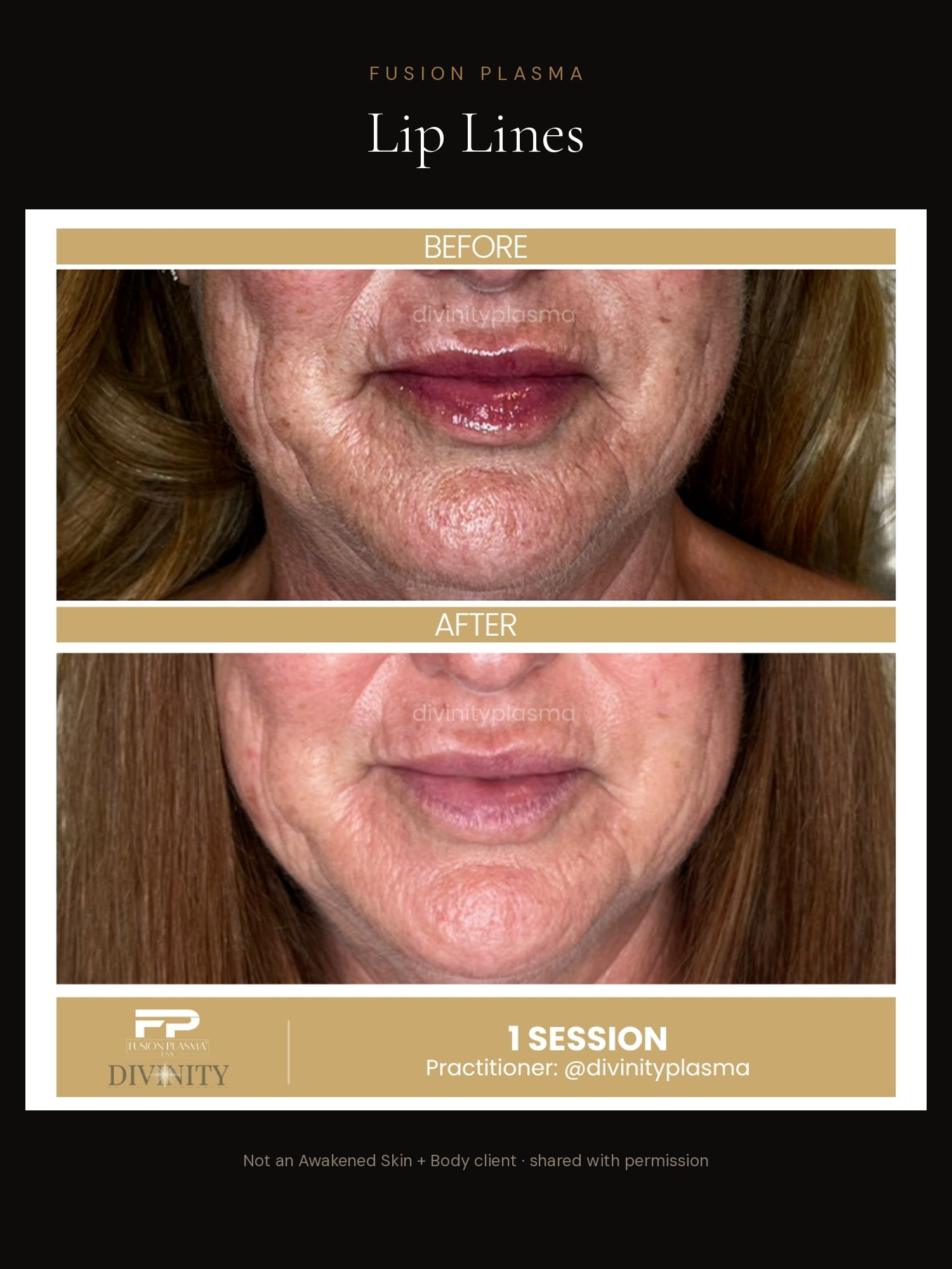 Lip Lines before and after, Fusion Plasma, result by a certified practitioner outside our studio