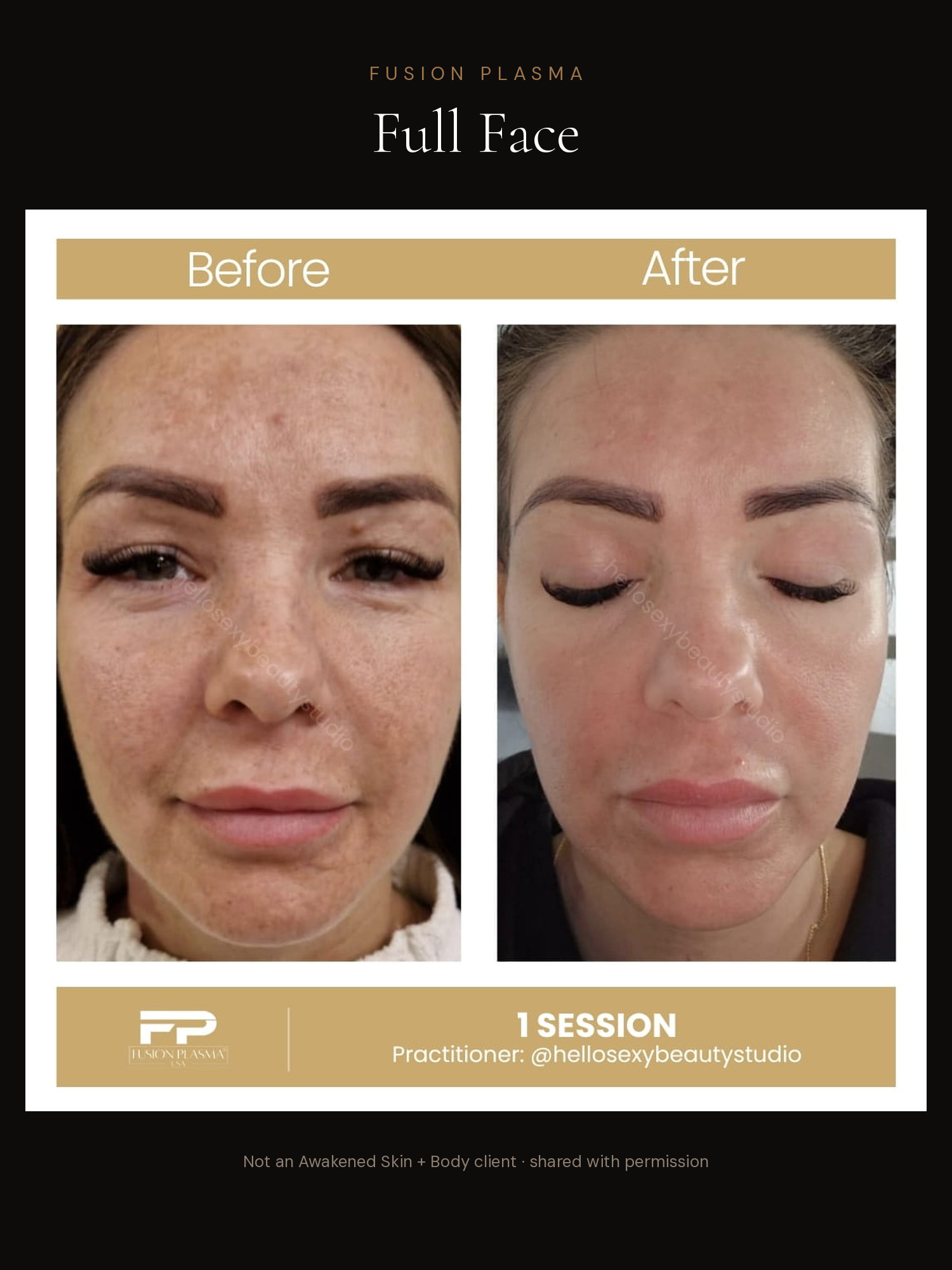 Full Face before and after, Fusion Plasma, result by a certified practitioner outside our studio