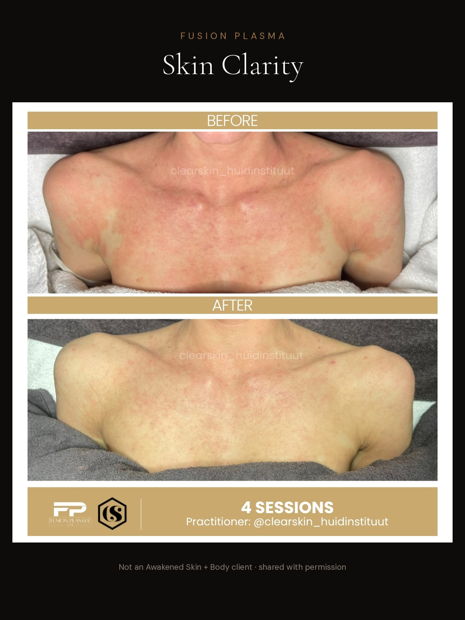 Skin Clarity before and after, Fusion Plasma, result by a certified practitioner outside our studio
