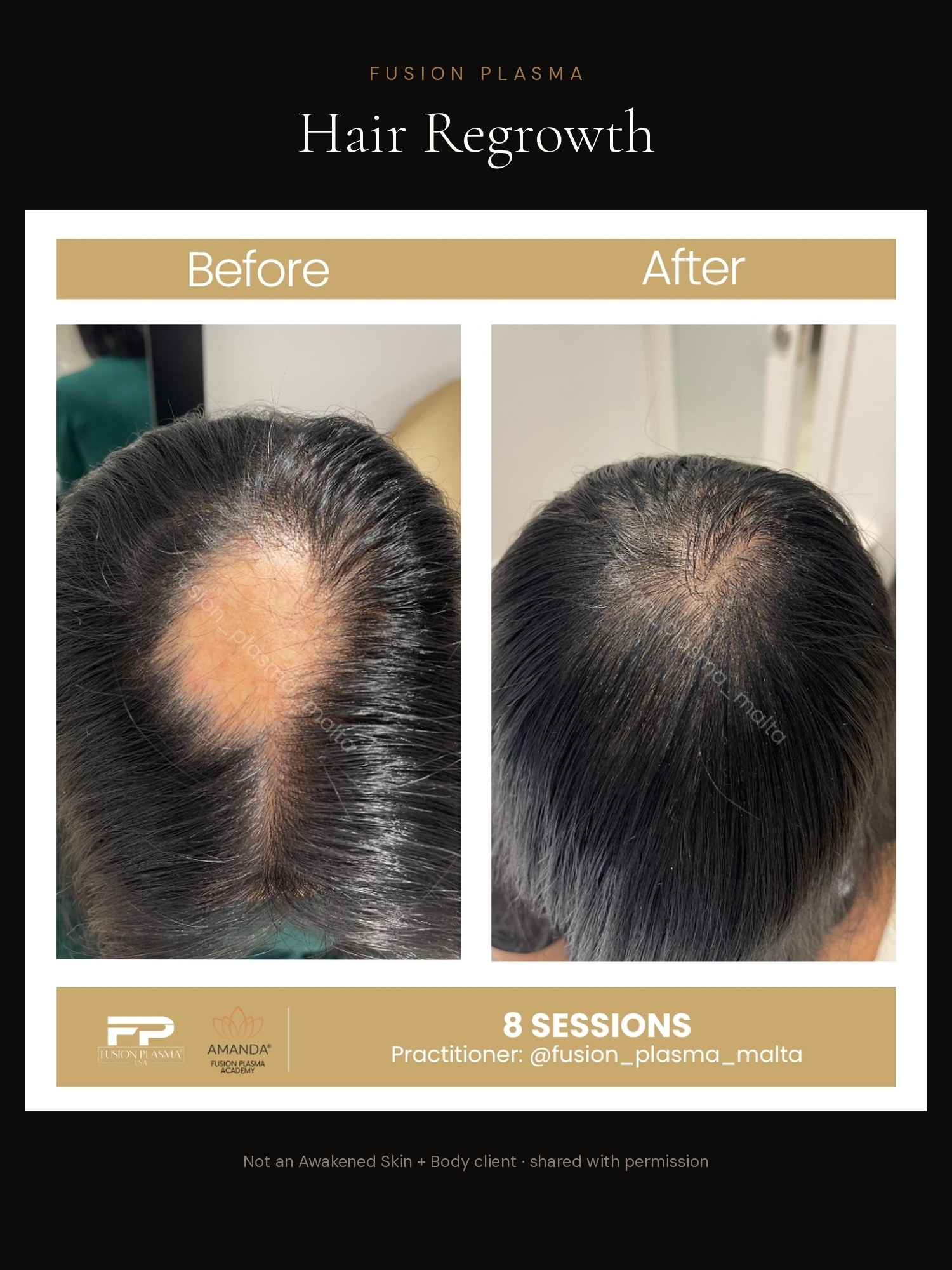 Hair Regrowth before and after, Fusion Plasma, result by a certified practitioner outside our studio