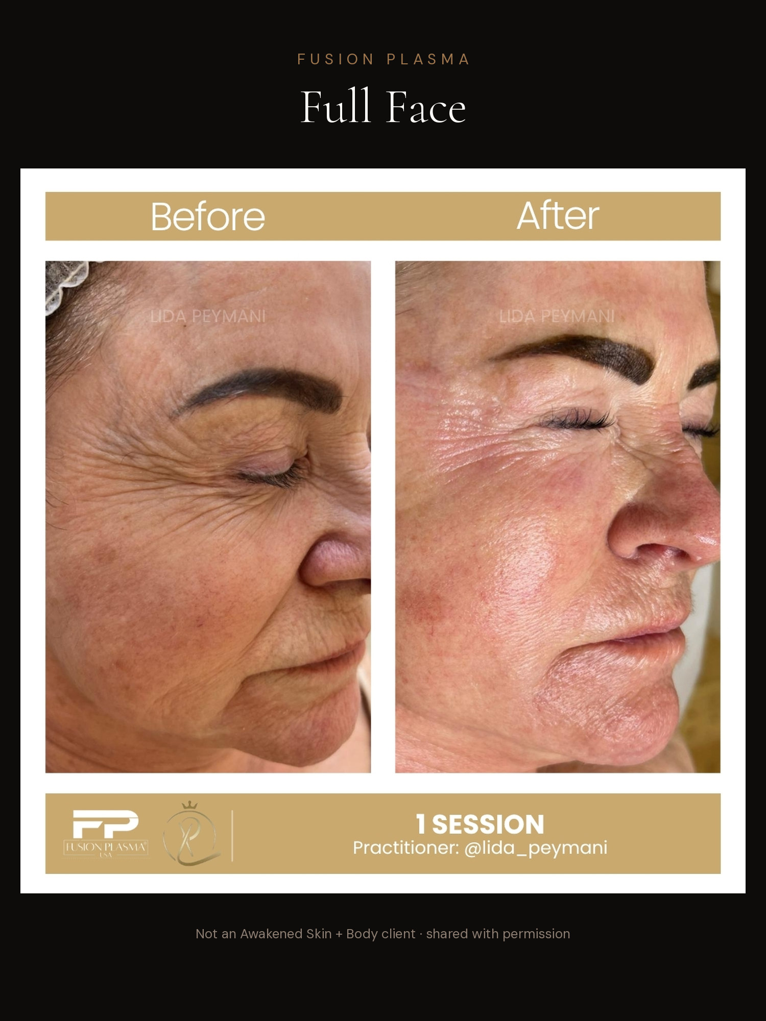 Full Face before and after, Fusion Plasma, result by a certified practitioner outside our studio