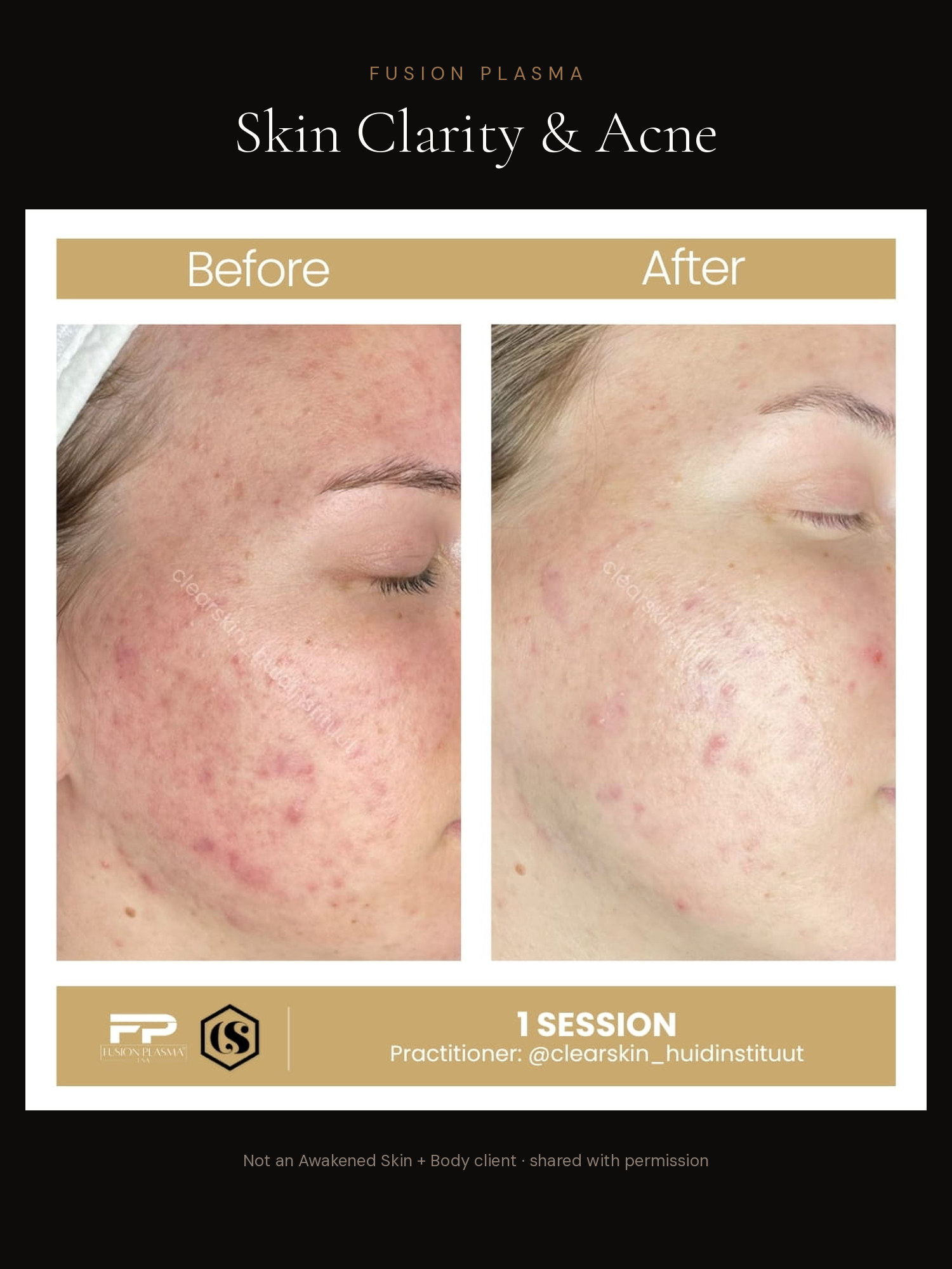Skin Clarity & Acne before and after, Fusion Plasma, result by a certified practitioner outside our studio