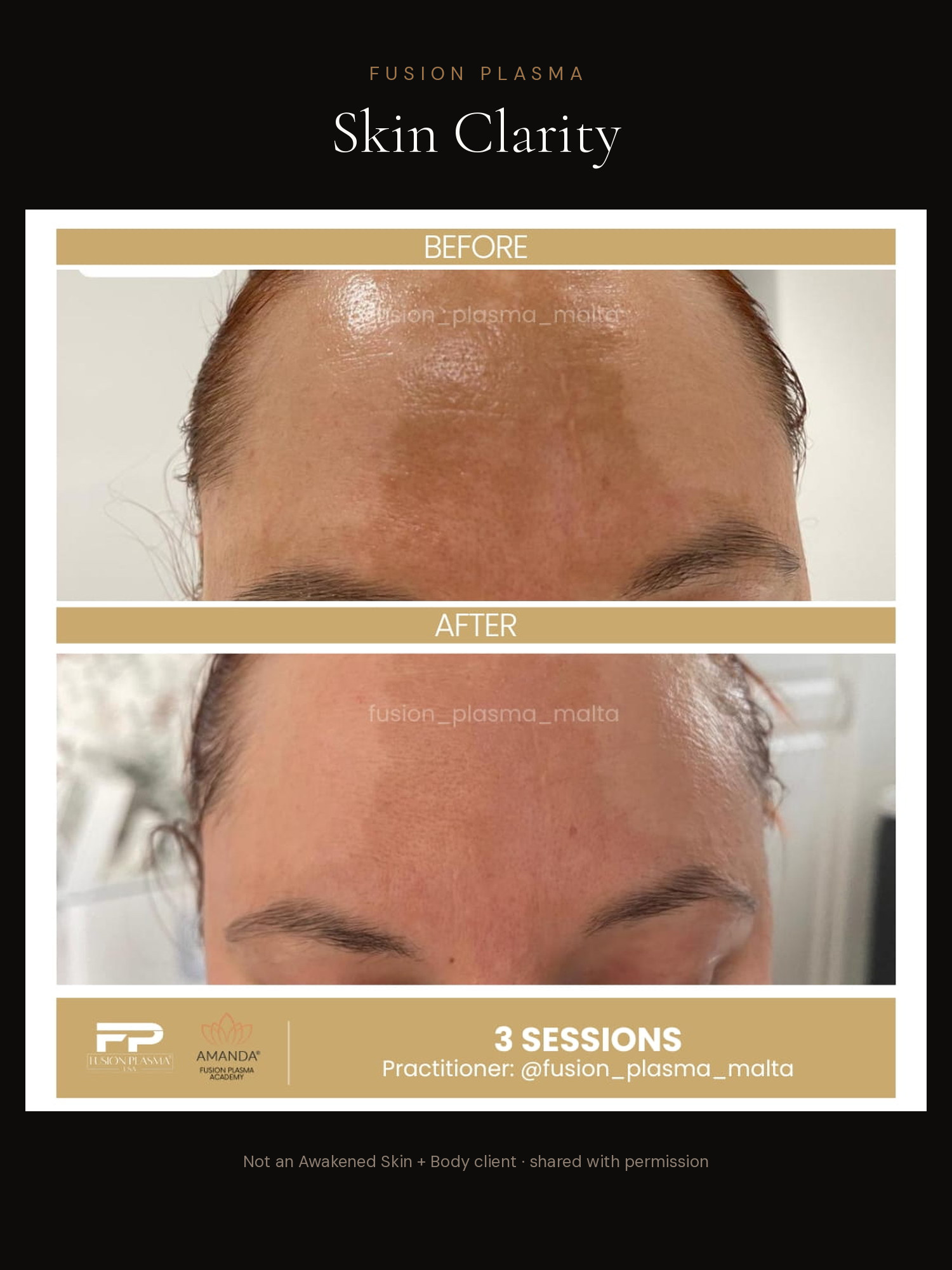 Skin Clarity before and after, Fusion Plasma, result by a certified practitioner outside our studio