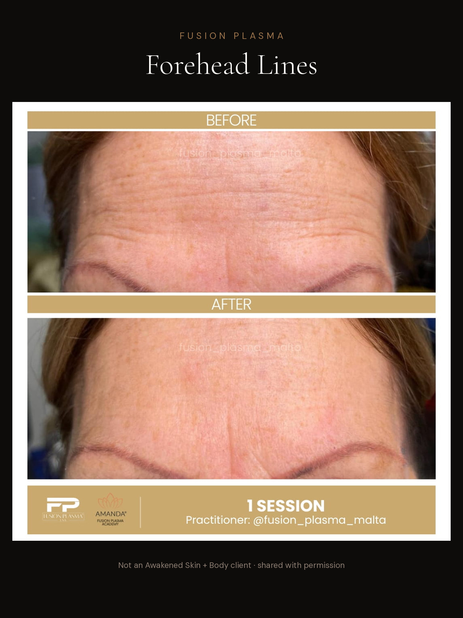 Forehead Lines before and after, Fusion Plasma, result by a certified practitioner outside our studio