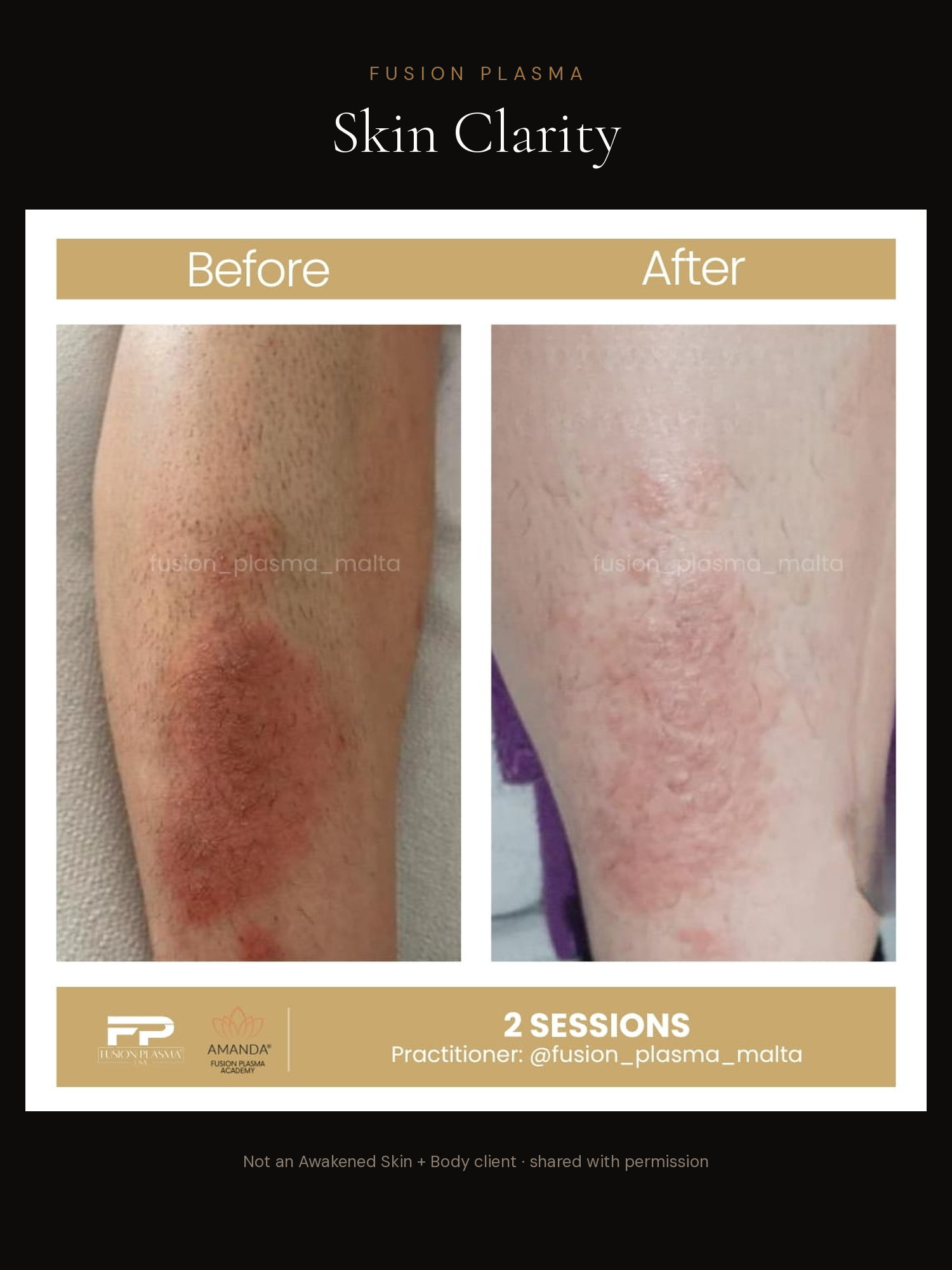Skin Clarity before and after, Fusion Plasma, result by a certified practitioner outside our studio