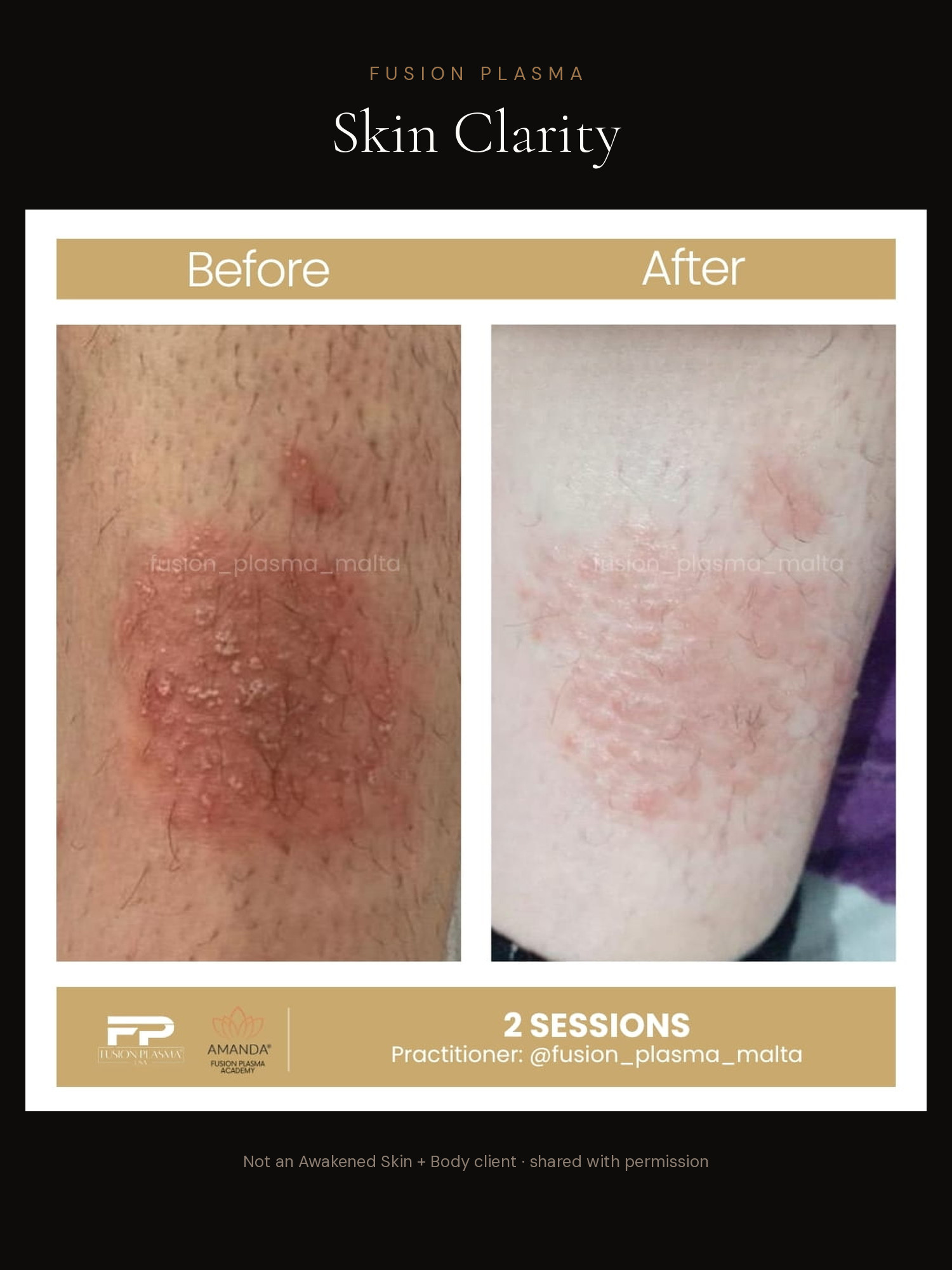 Skin Clarity before and after, Fusion Plasma, result by a certified practitioner outside our studio