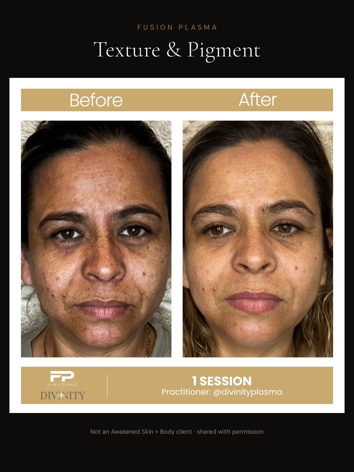 Texture & Pigment before and after, Fusion Plasma, result by a certified practitioner outside our studio