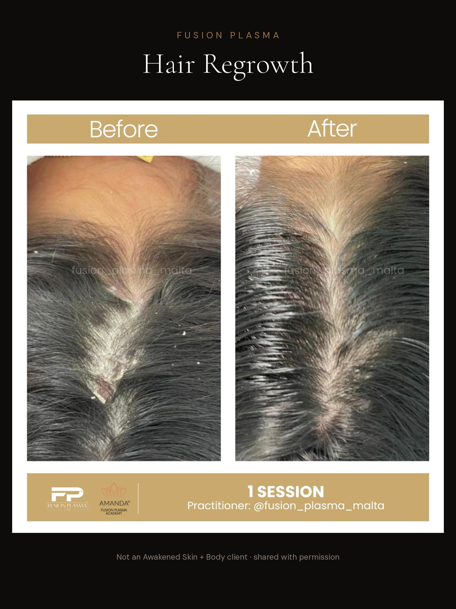 Hair Regrowth before and after, Fusion Plasma, result by a certified practitioner outside our studio