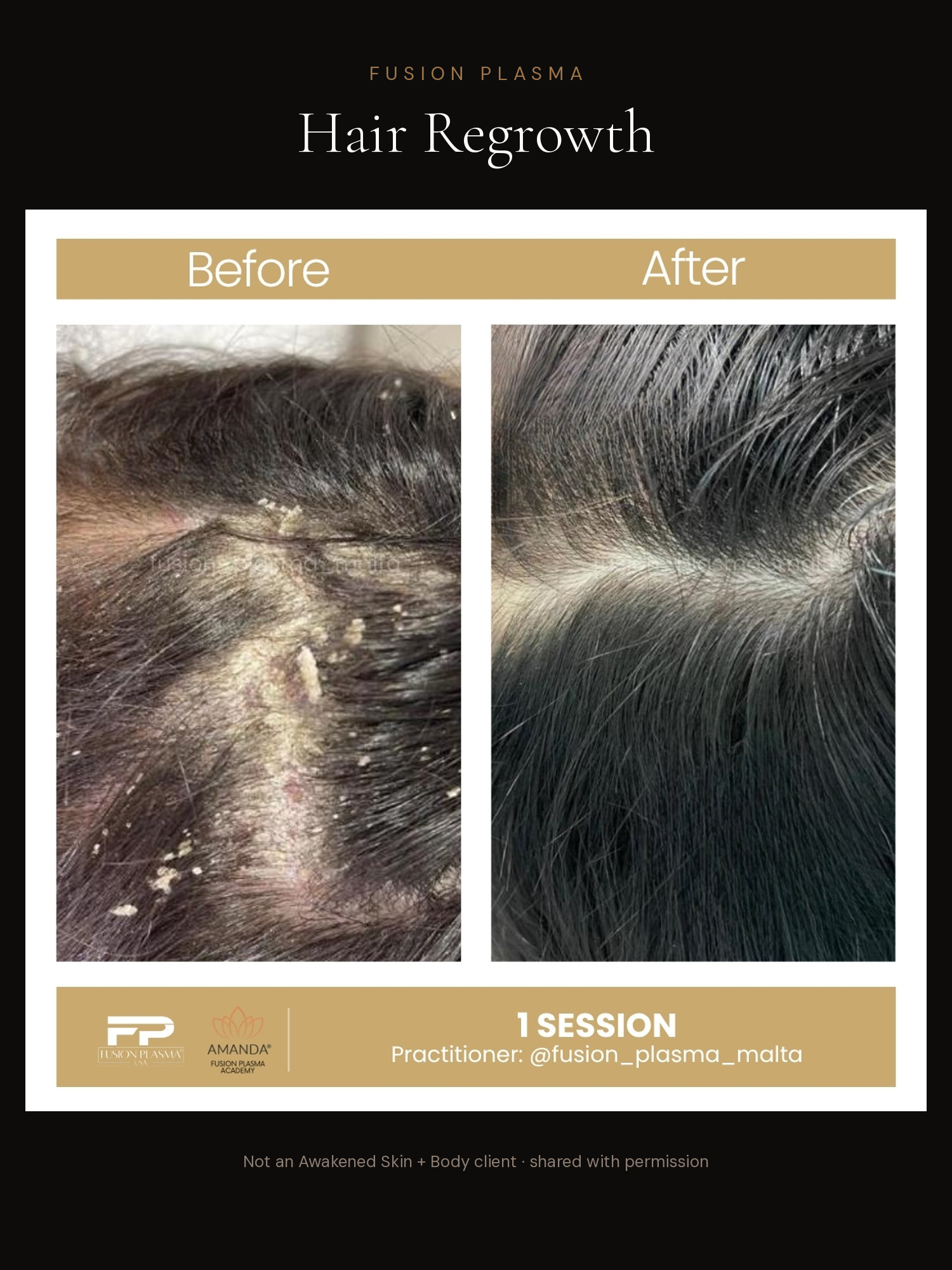 Hair Regrowth before and after, Fusion Plasma, result by a certified practitioner outside our studio