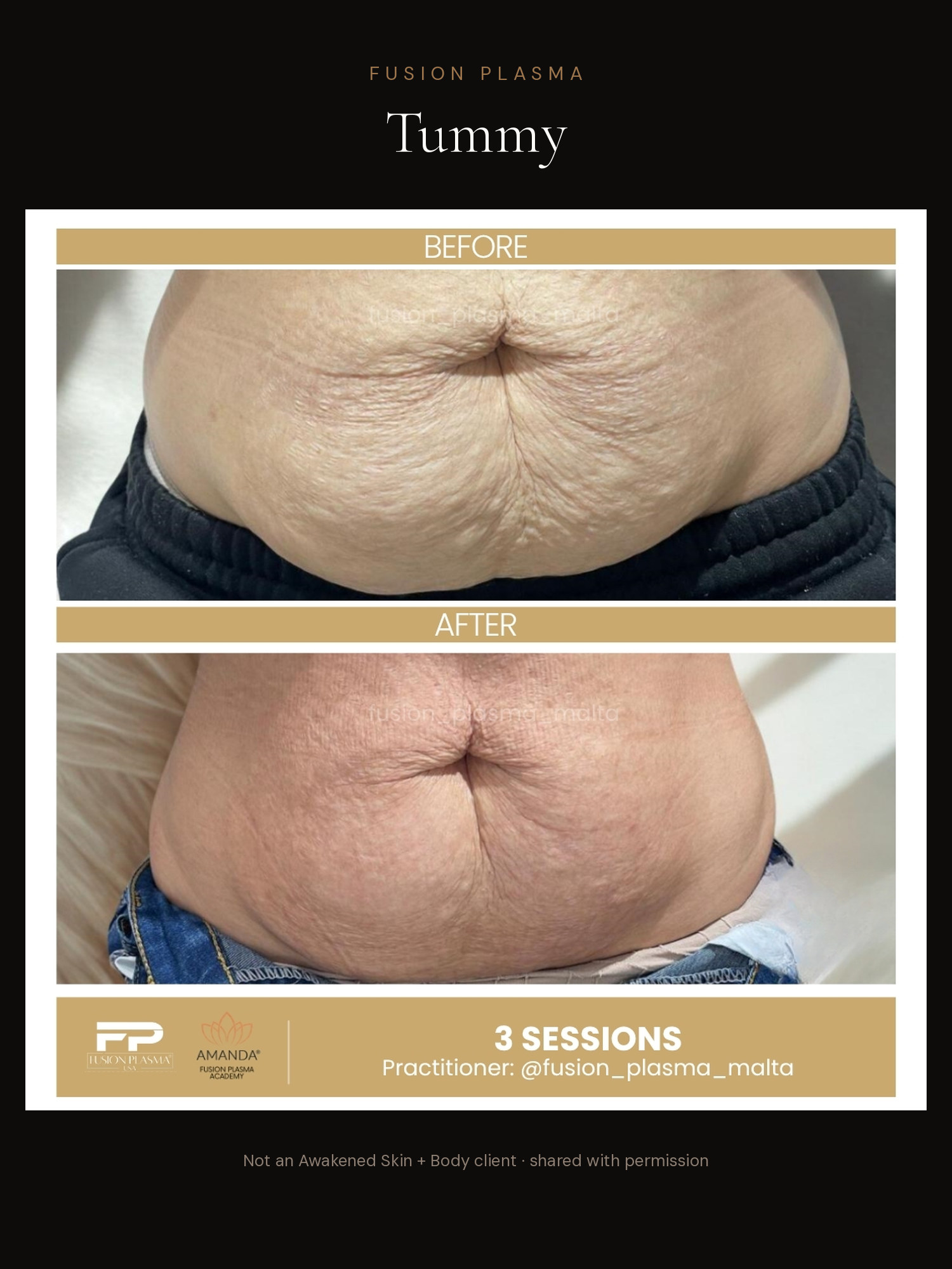 Tummy before and after, Fusion Plasma, result by a certified practitioner outside our studio