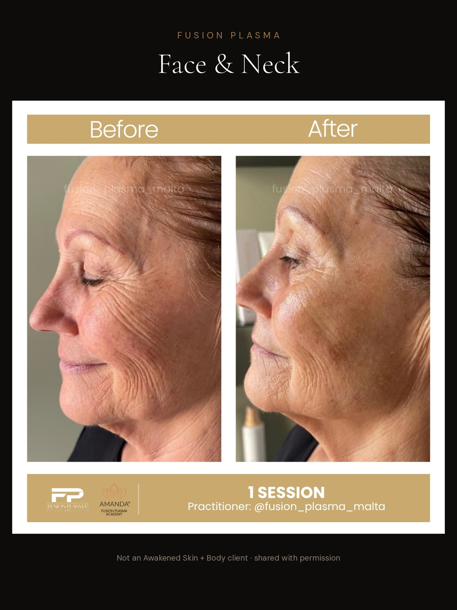 Face & Neck before and after, Fusion Plasma, result by a certified practitioner outside our studio