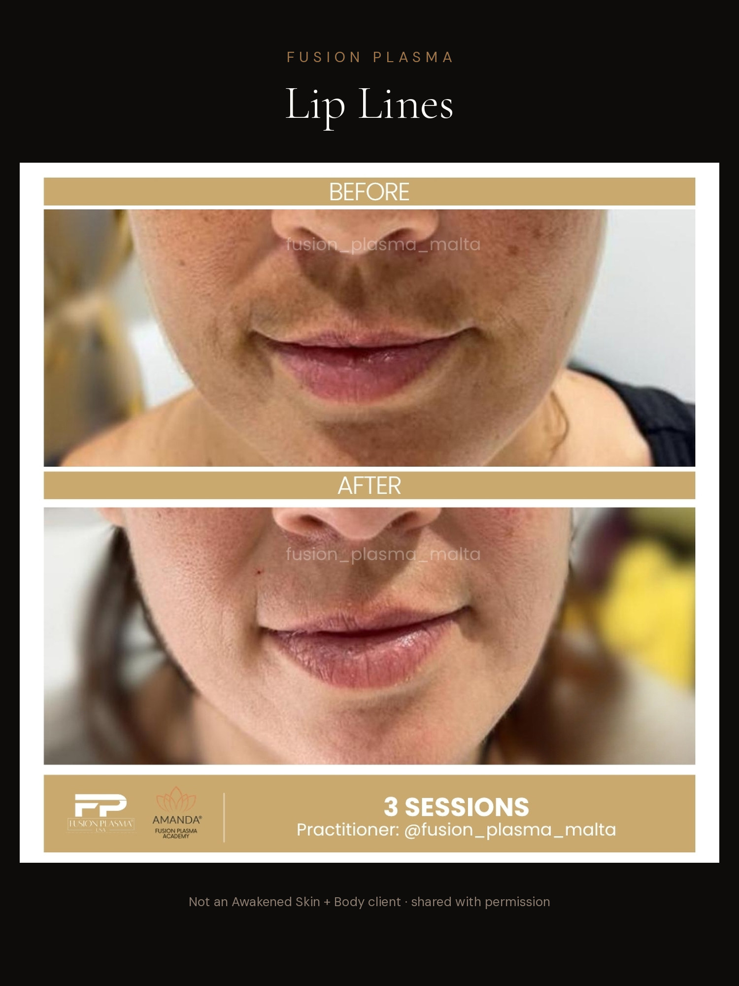 Lip Lines before and after, Fusion Plasma, result by a certified practitioner outside our studio