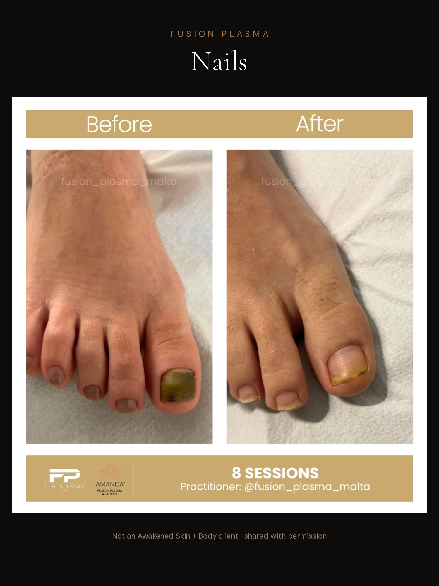 Nails before and after, Fusion Plasma, result by a certified practitioner outside our studio