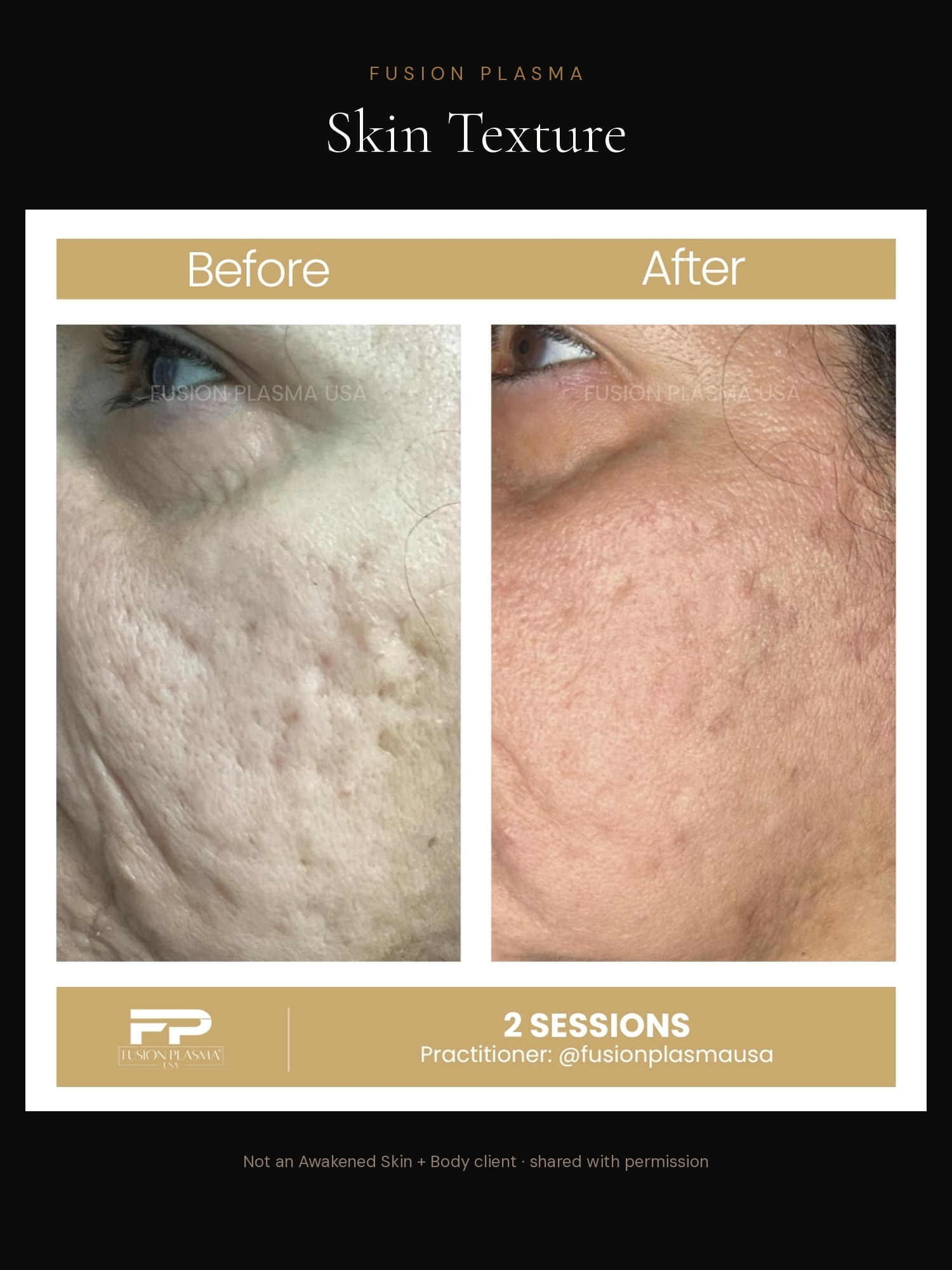 Skin Texture before and after, Fusion Plasma, result by a certified practitioner outside our studio